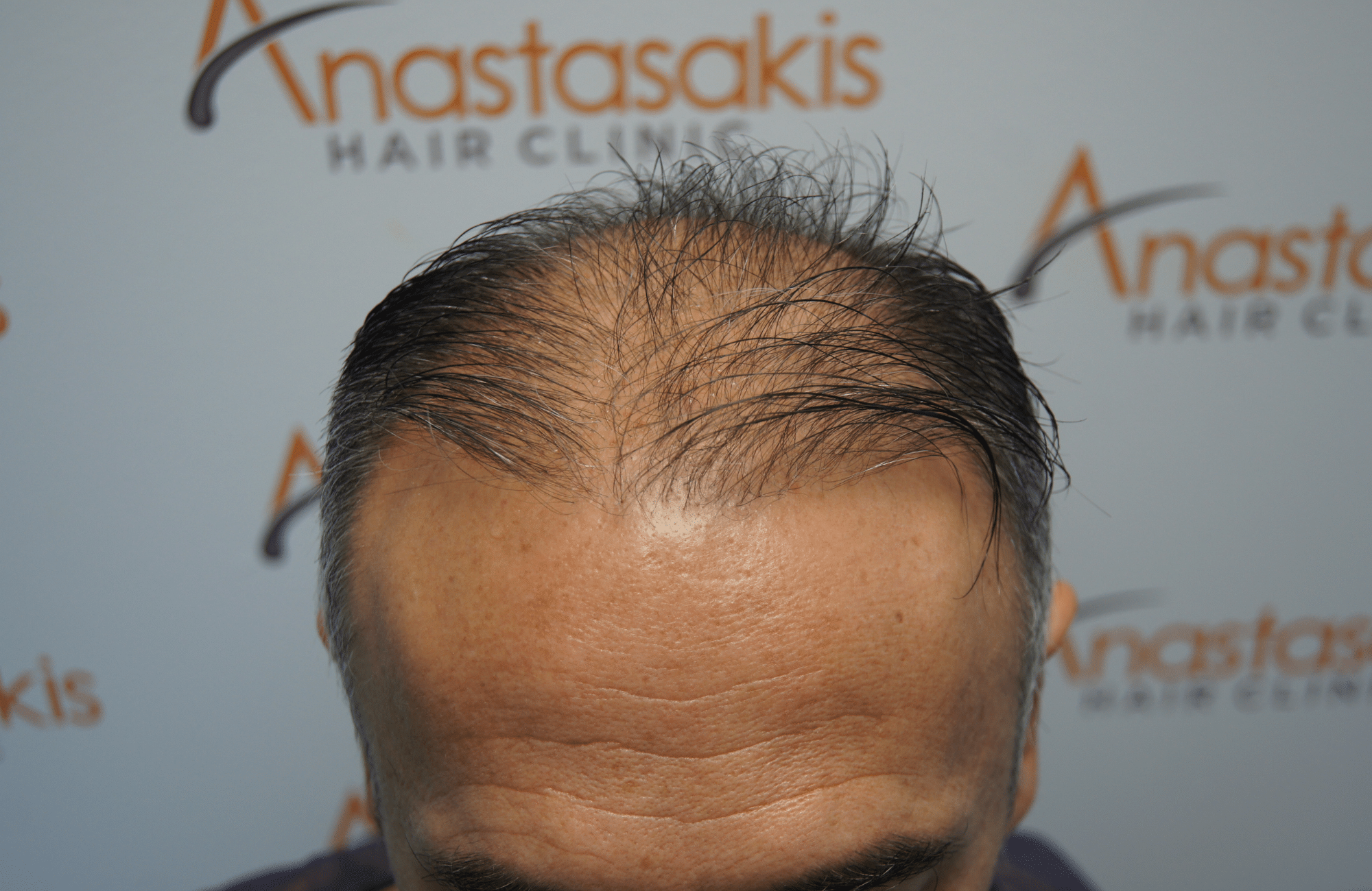 hair transplant result with 1700 grafts before - frontal