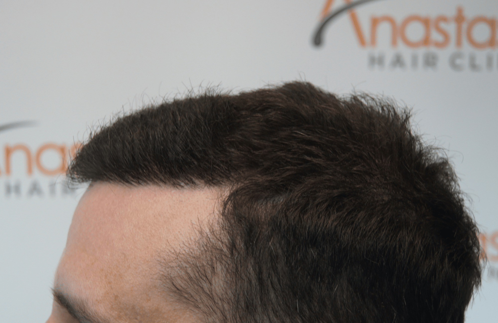 hair transplant result with 2500 grafts thick hair after - side3