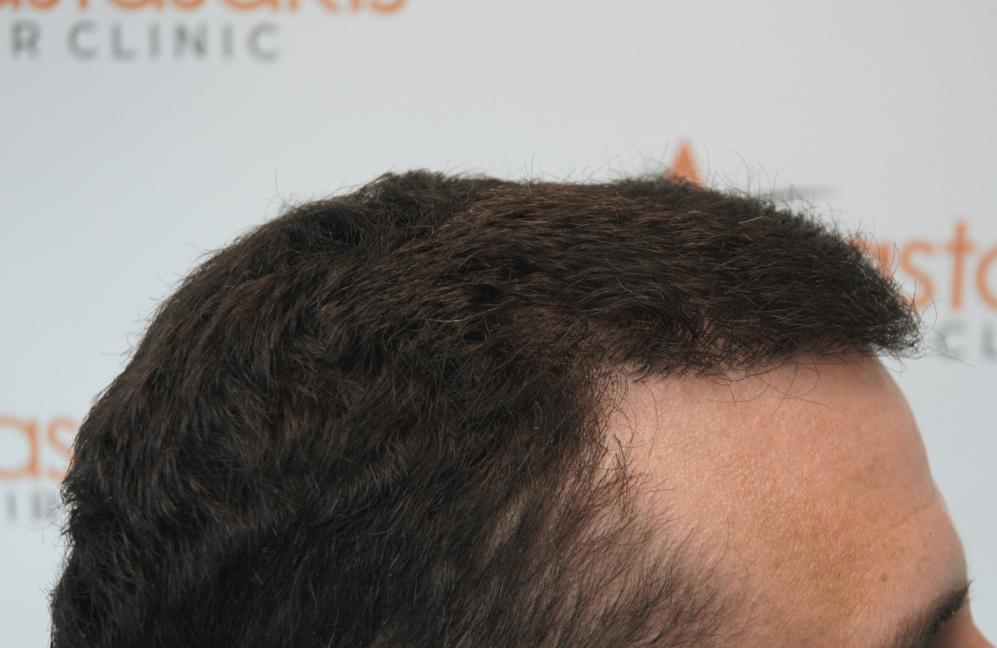 hair transplant result with 2500 grafts thick hair after - side4