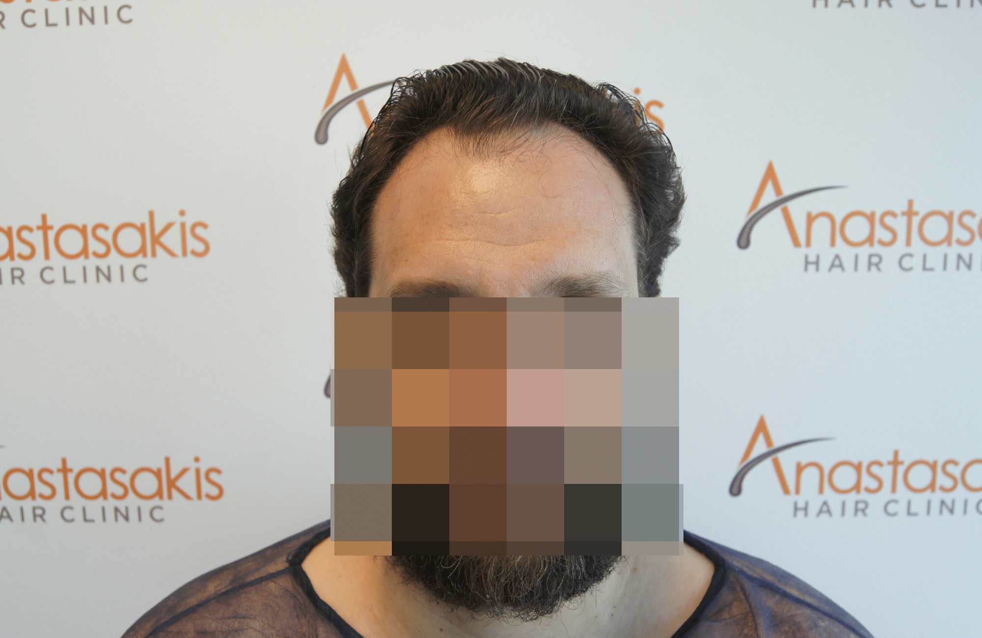 hair transplant result with 2500 grafts thick hair before - fullface