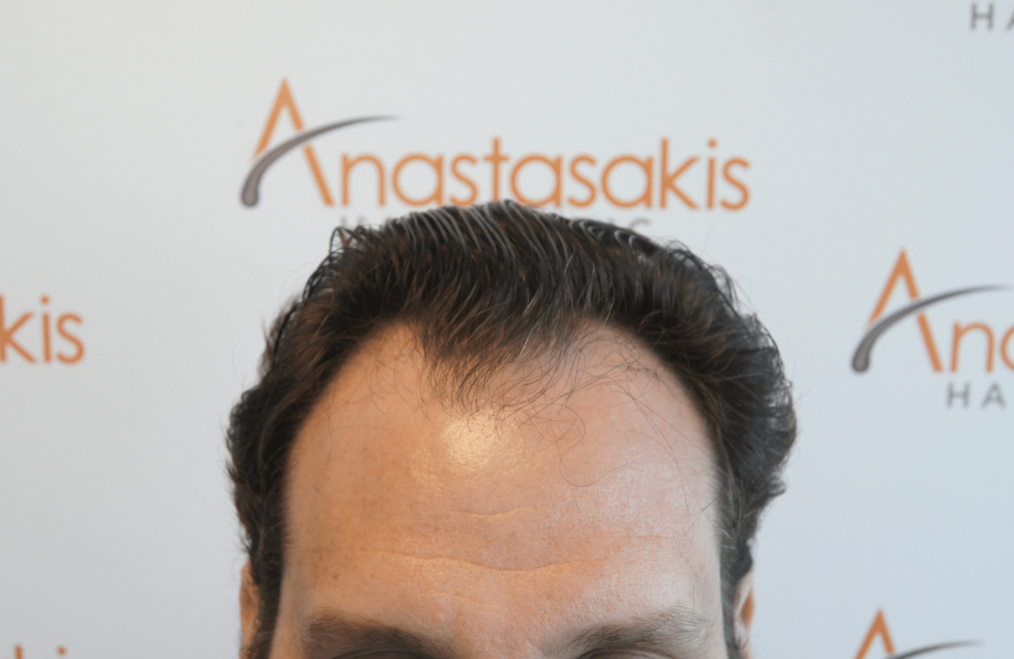 hair transplant result with 2500 grafts thick hair before - hairline