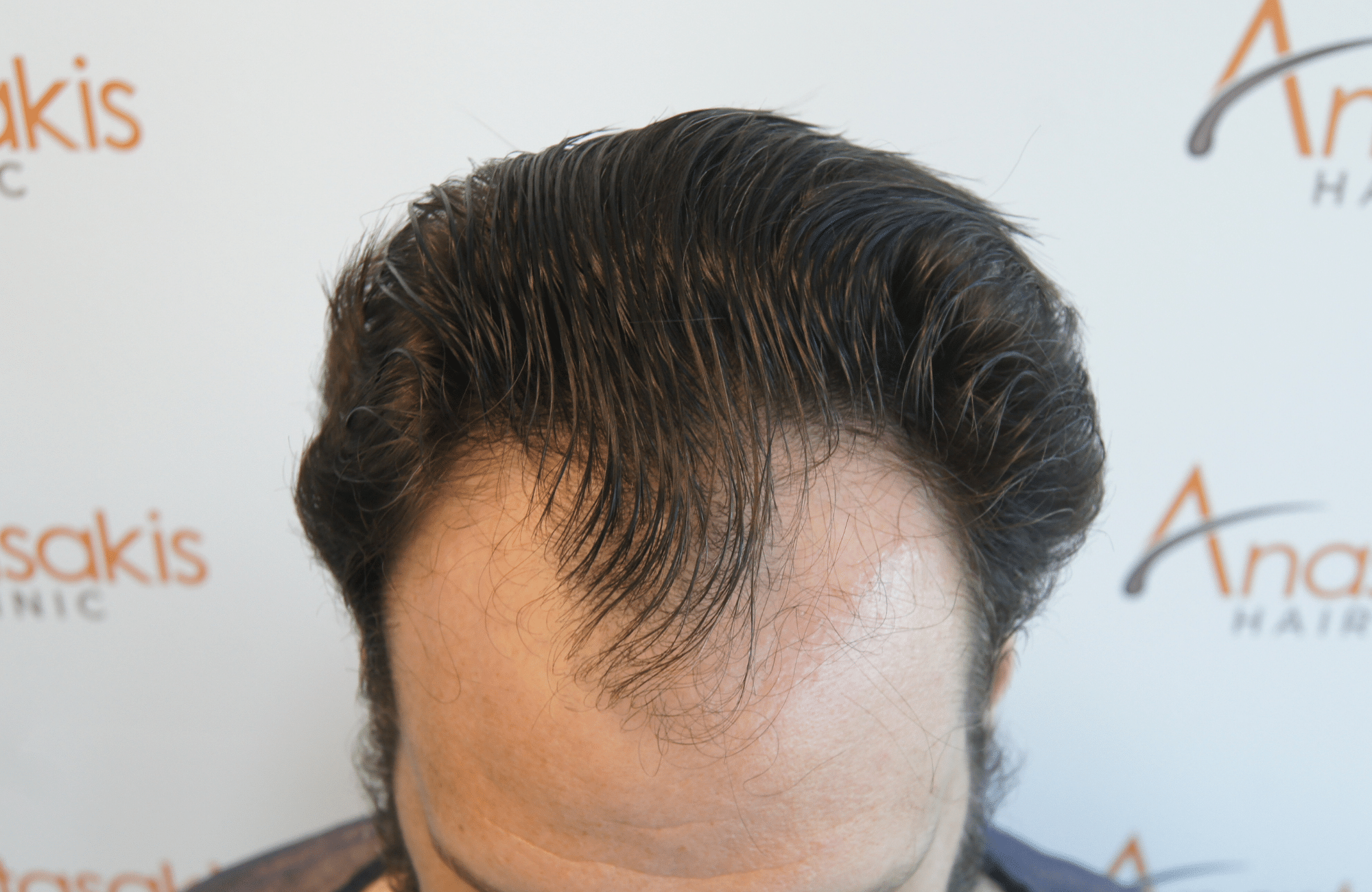 hair transplant result with 2500 grafts thick hair before - frontal