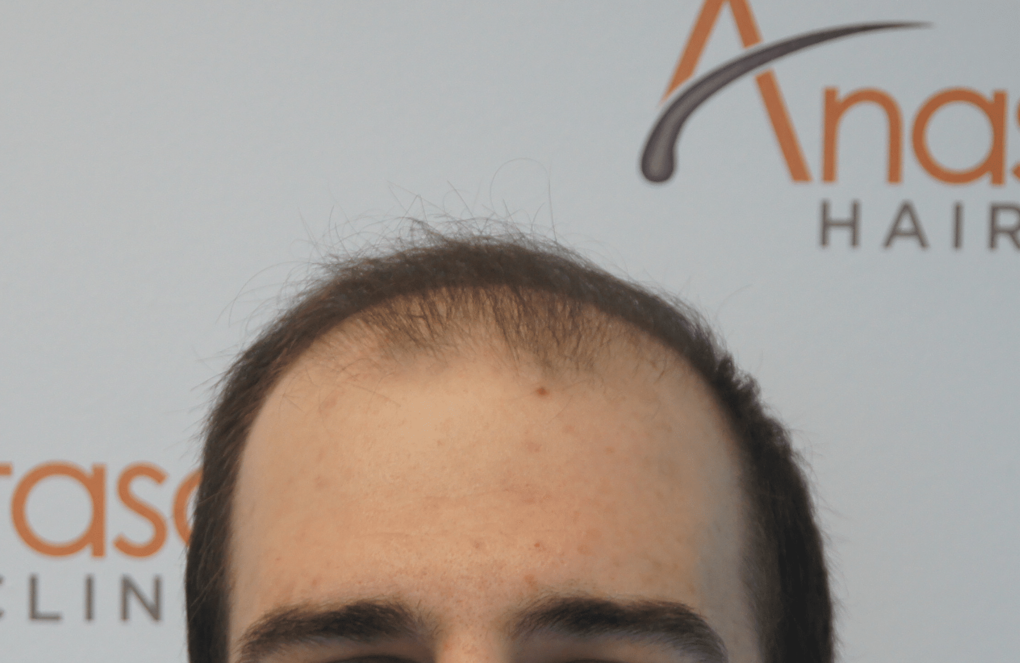 hair transplant result with 3000 grafts - before - hairline