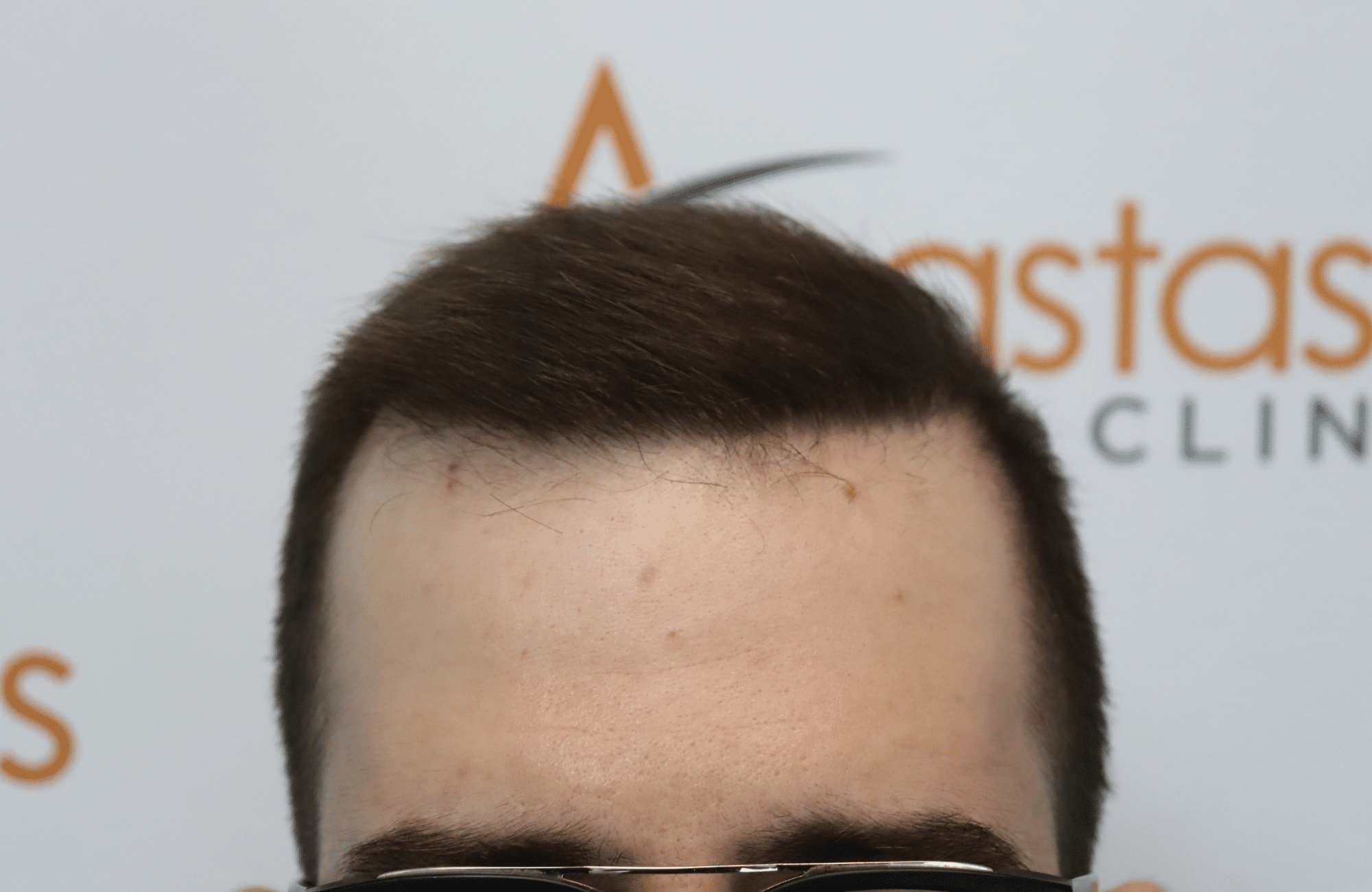 hair transplant result with 3000 grafts - after - hairline
