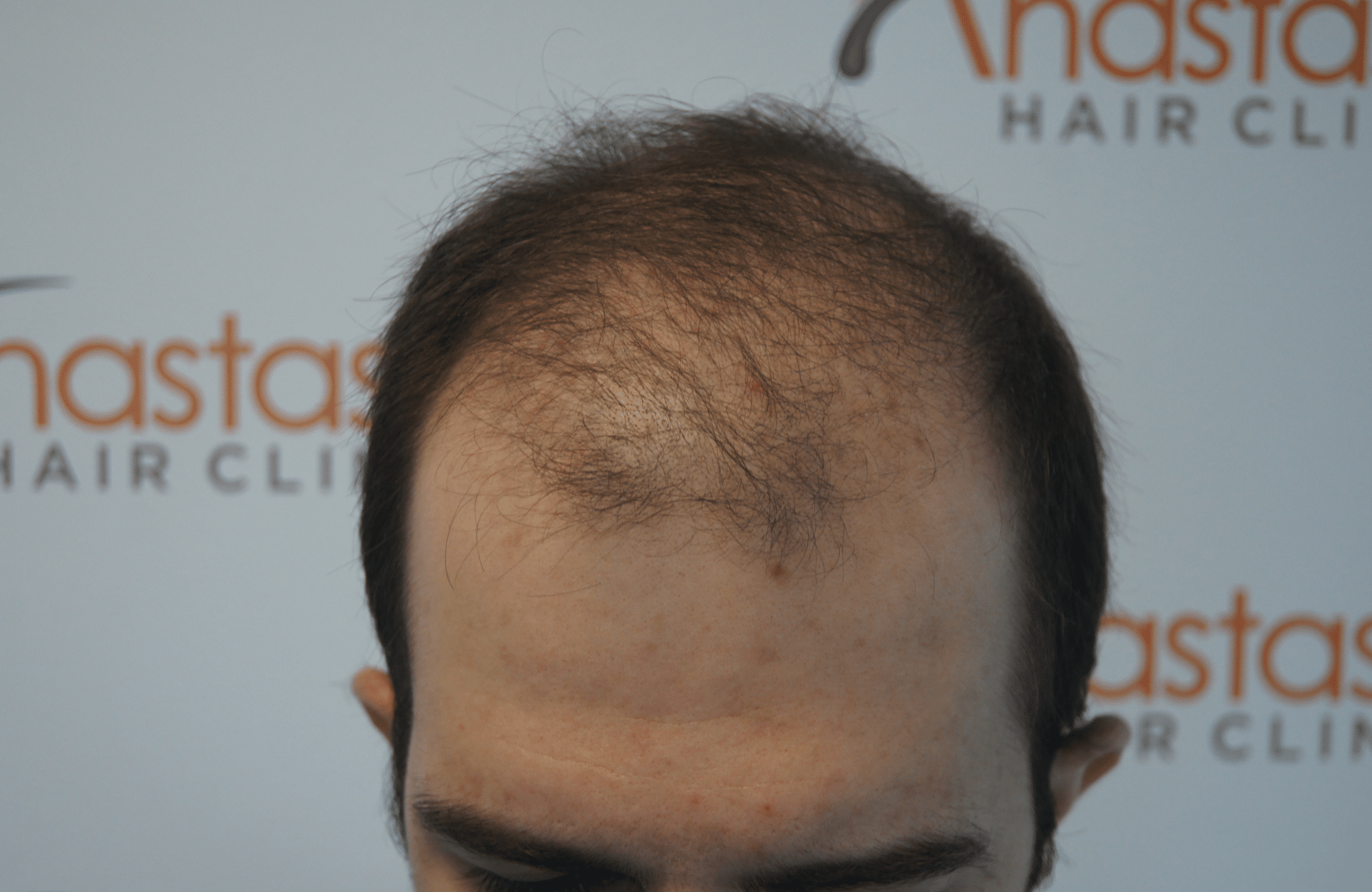 hair transplant result with 3000 grafts - before - frontal