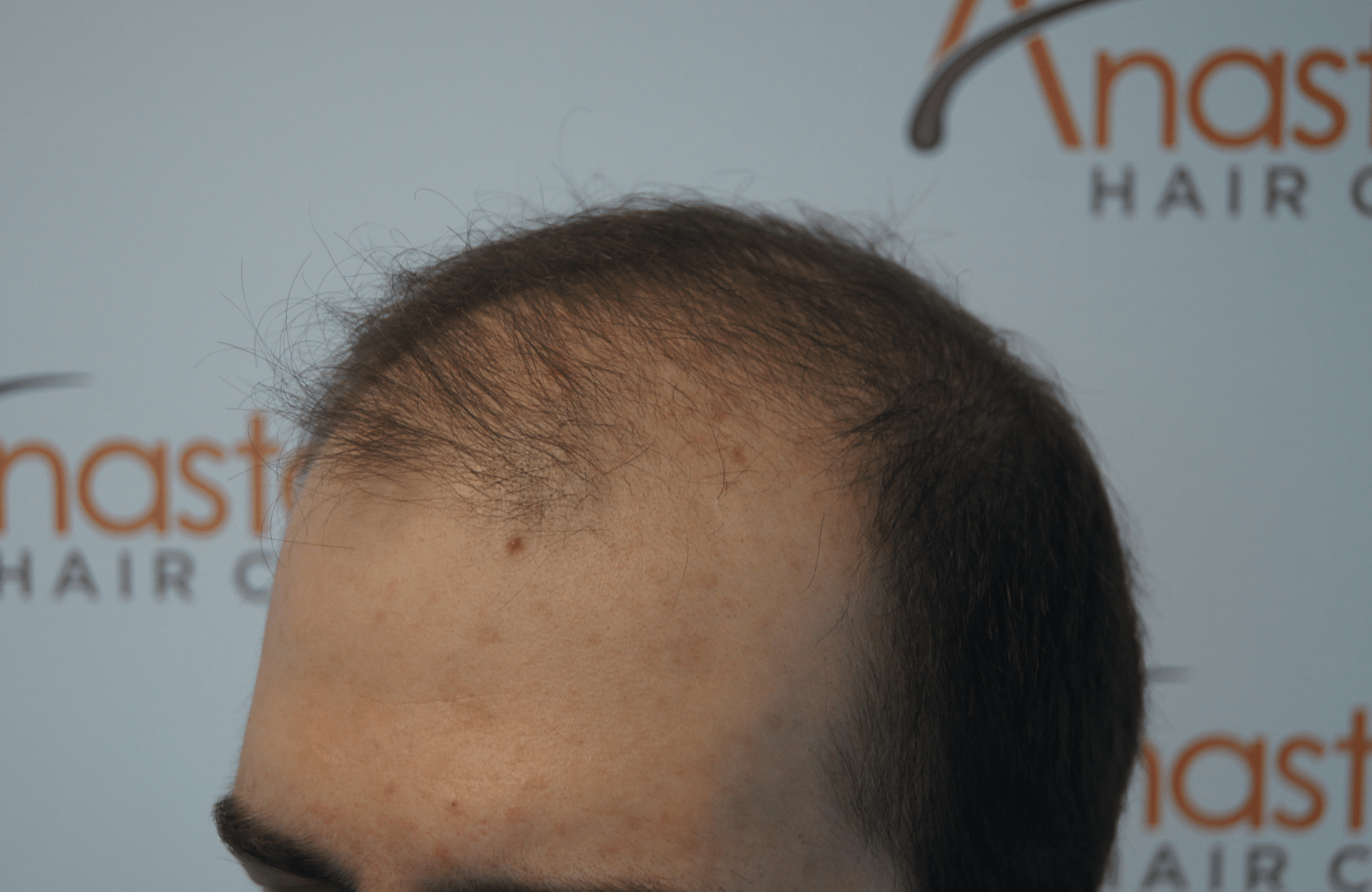 hair transplant result with 3000 grafts - before - side1