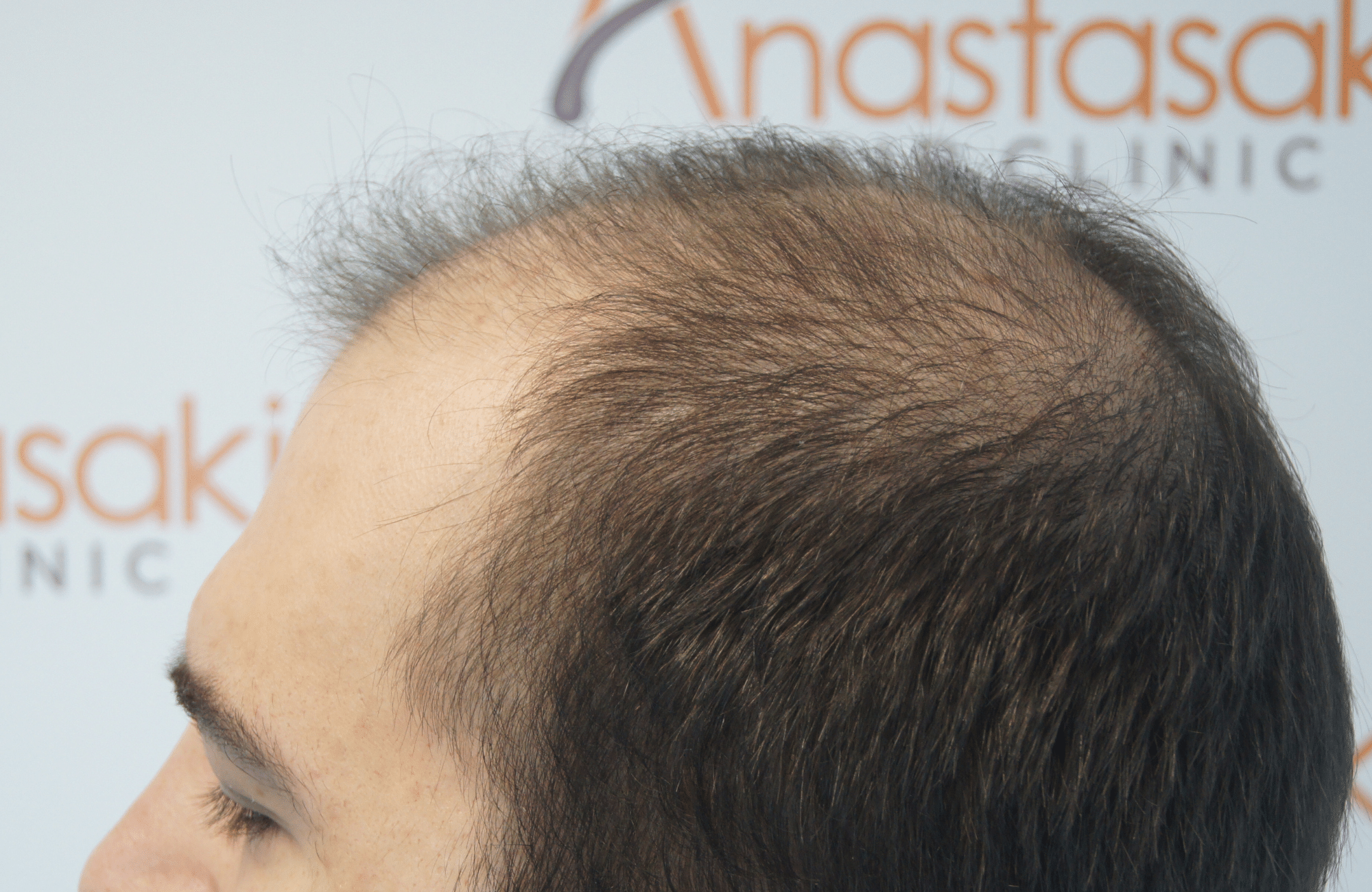 hair transplant result with 3000 grafts - before - side2
