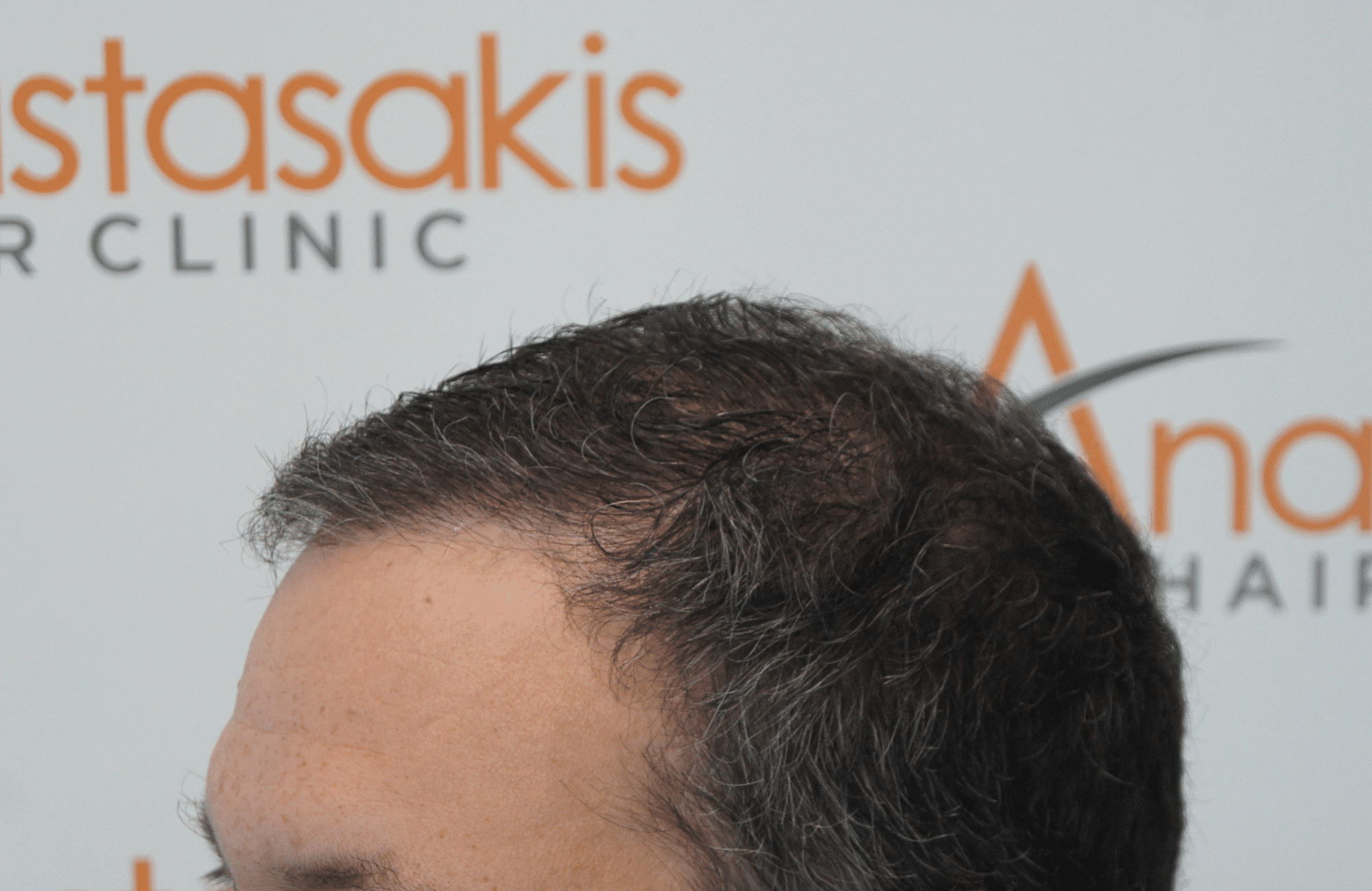 hair transplant result with 3500 grafts - before - side1