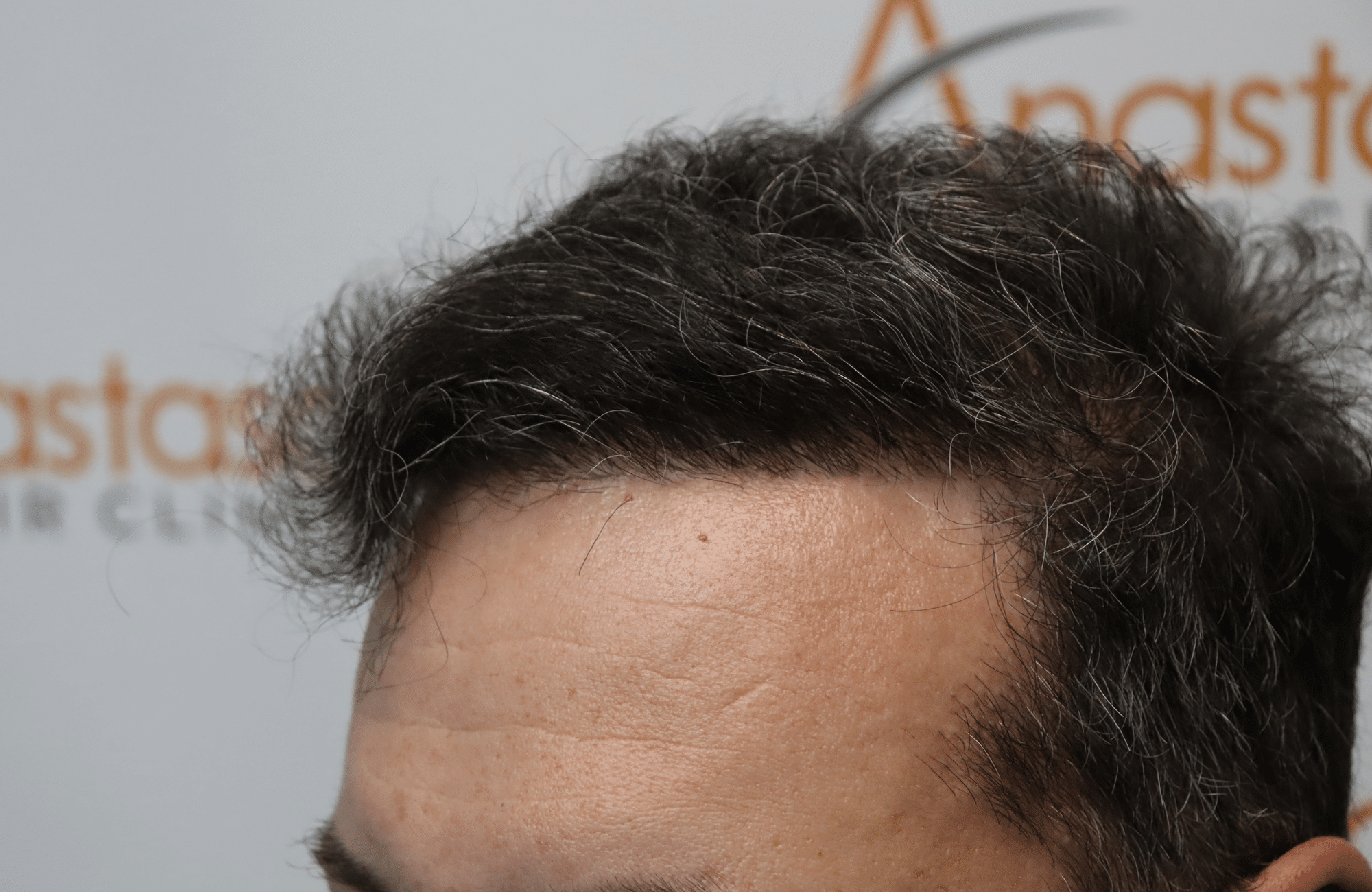 hair transplant result with 3500 grafts - after - side1