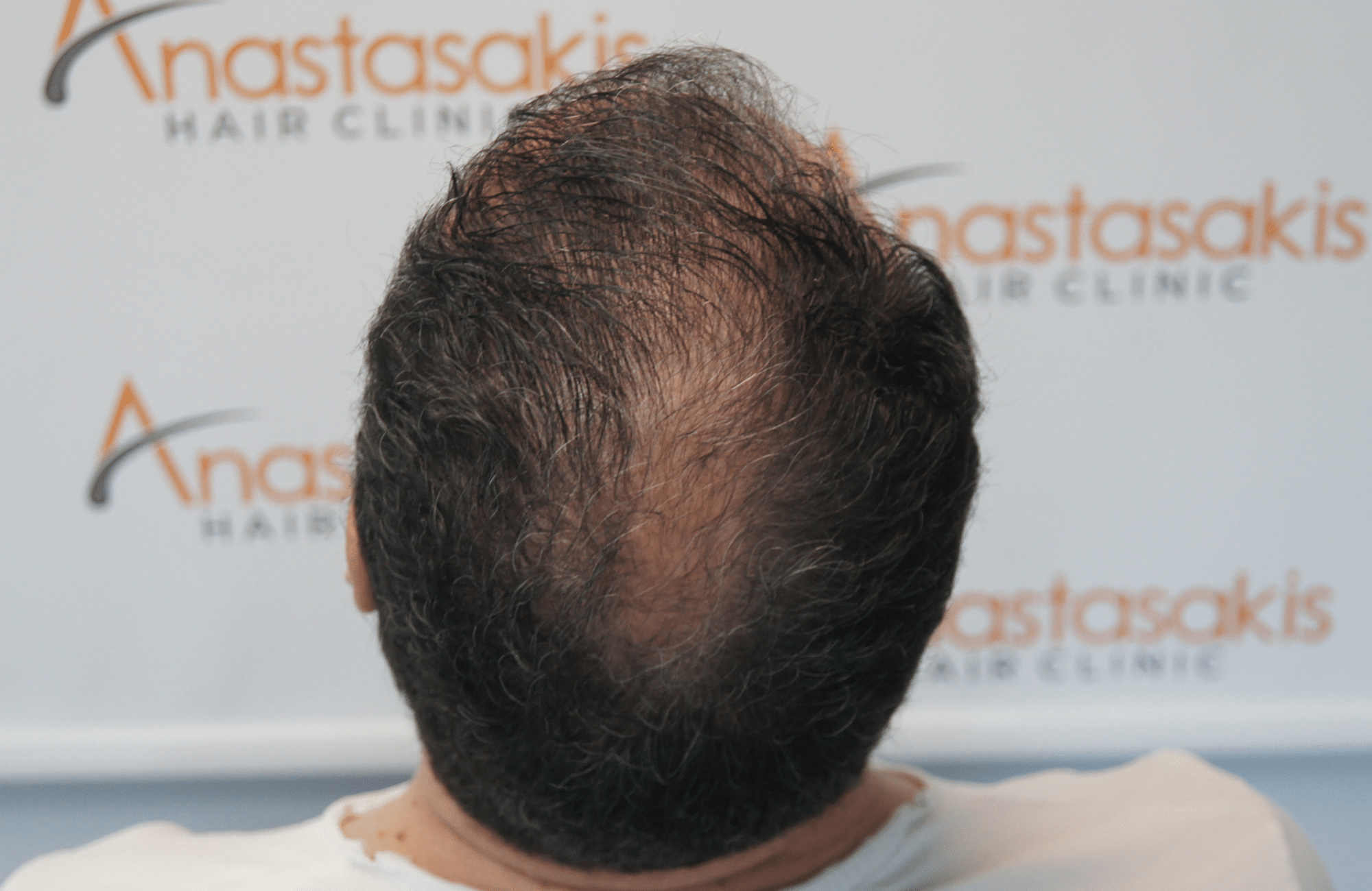 hair transplant result with 3500 grafts - before - crown