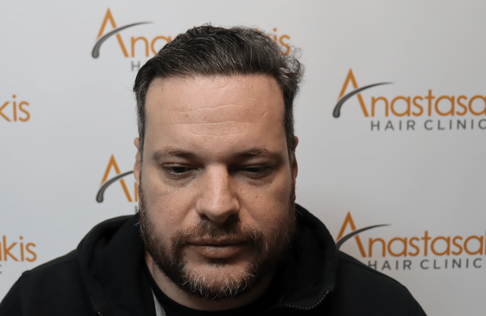 hair transplant result with 3500 grafts - after - fullface with wet hair