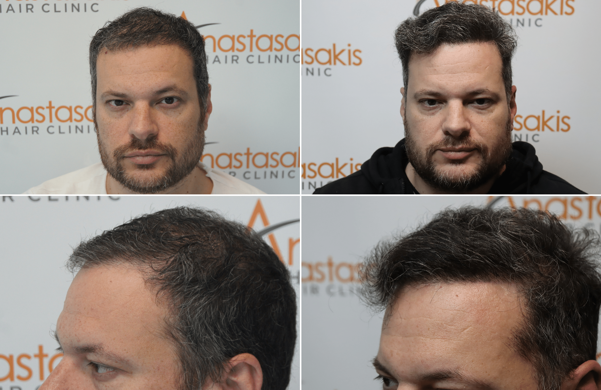 https://anastasakishairclinic.com/portfolio/apotelesma-metamosxefsis-mallion-anastasakis-hair-clinic-435/