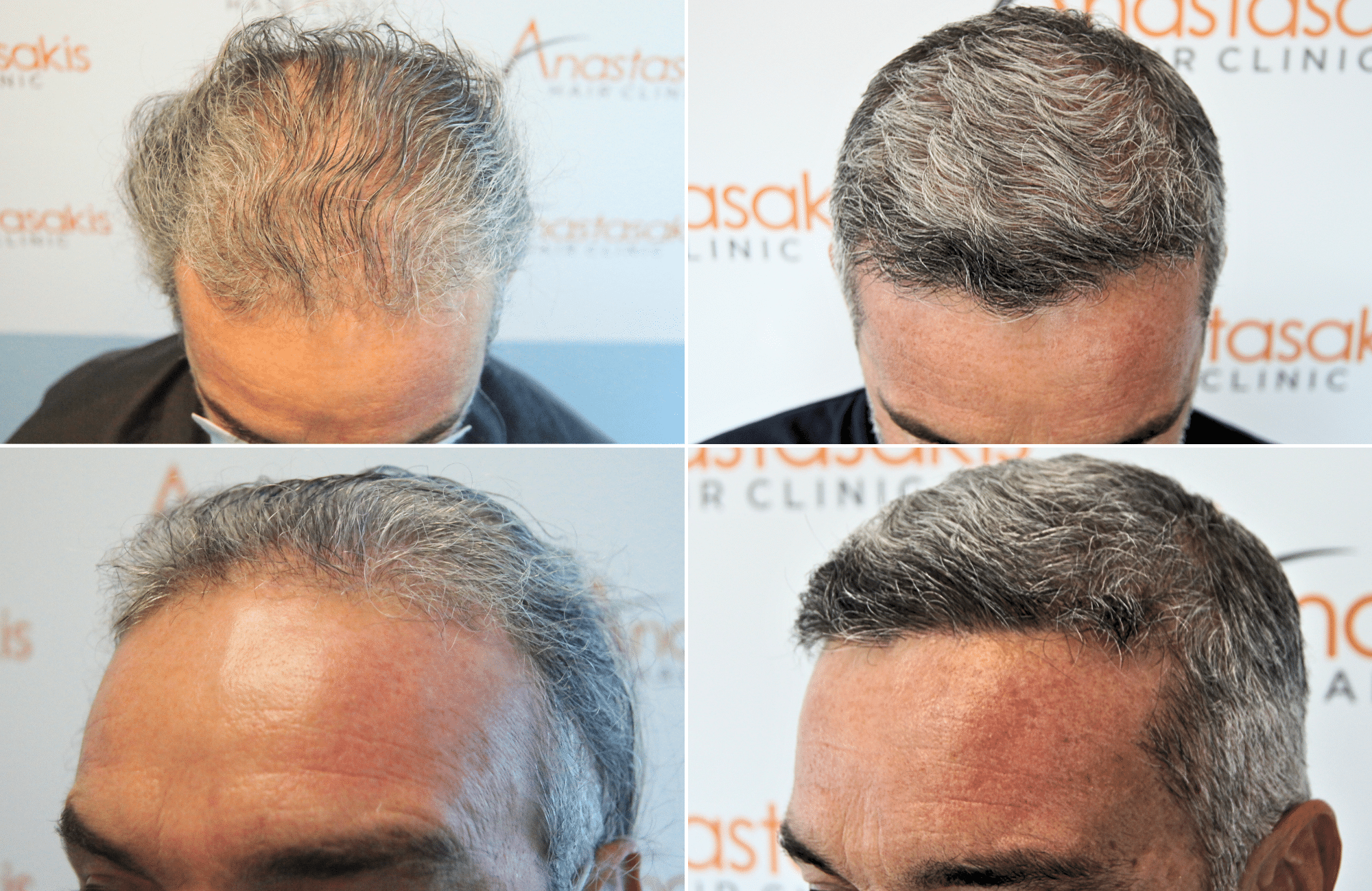 https://anastasakishairclinic.com/portfolio/apotelesma-metamosxefsis-mallion-anastasakis-hair-clinic-416/