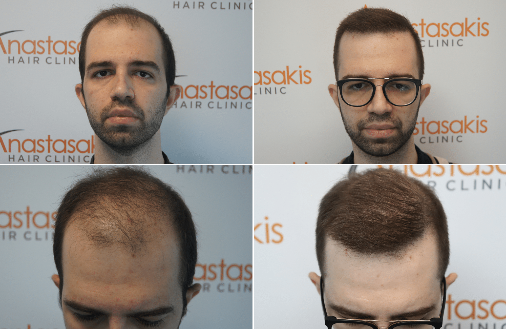 https://anastasakishairclinic.com/portfolio/apotelesma-metamosxefsis-mallion-anastasakis-hair-clinic-432/