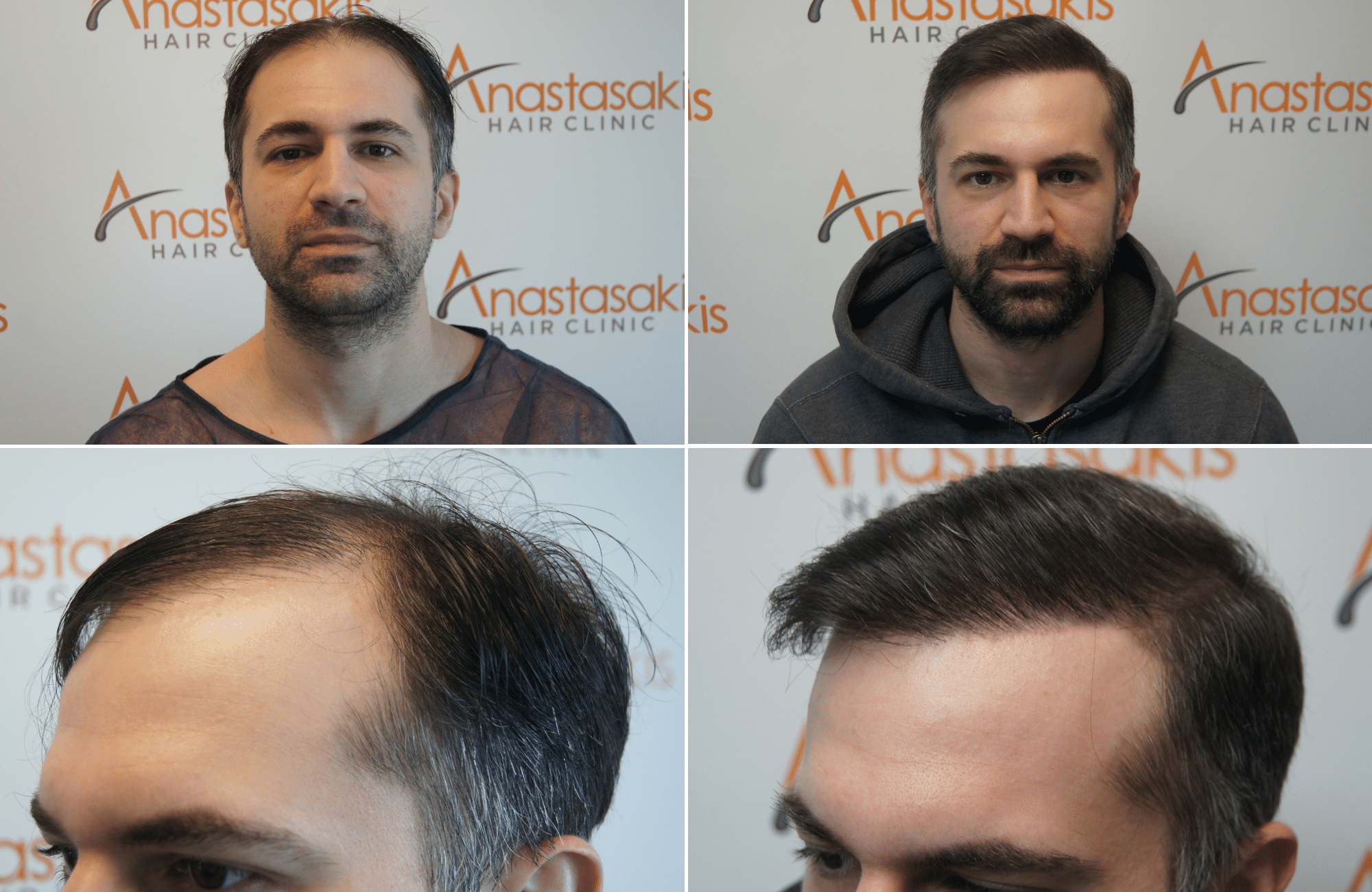 https://anastasakishairclinic.com/portfolio/apotelesma-metamosxefsis-mallion-anastasakis-hair-clinic-431/