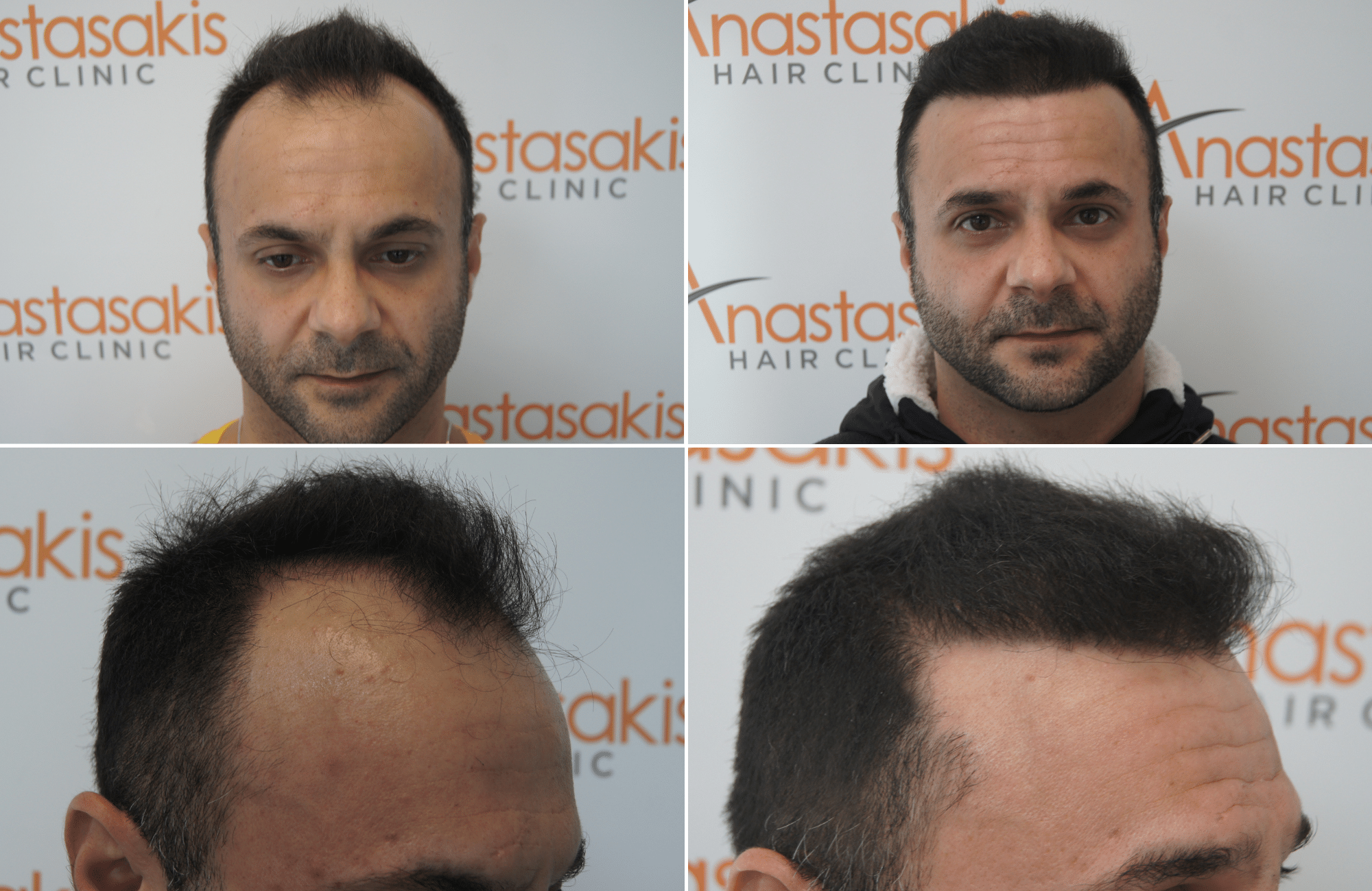 https://anastasakishairclinic.com/portfolio/apotelesma-metamosxefsis-mallion-anastasakis-hair-clinic-430/