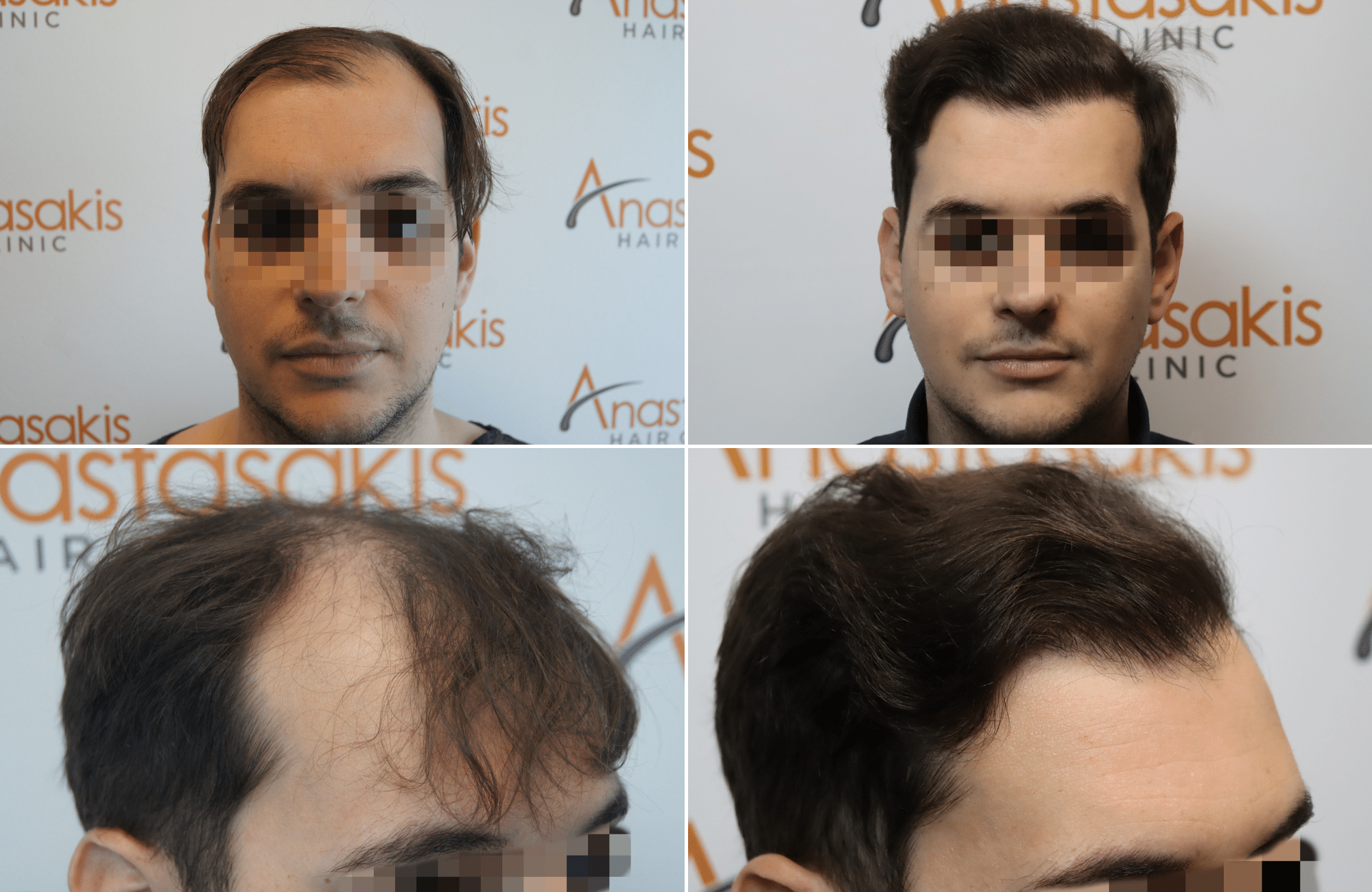 https://anastasakishairclinic.com/portfolio/apotelesma-metamosxefsis-mallion-anastasakis-hair-clinic-434/