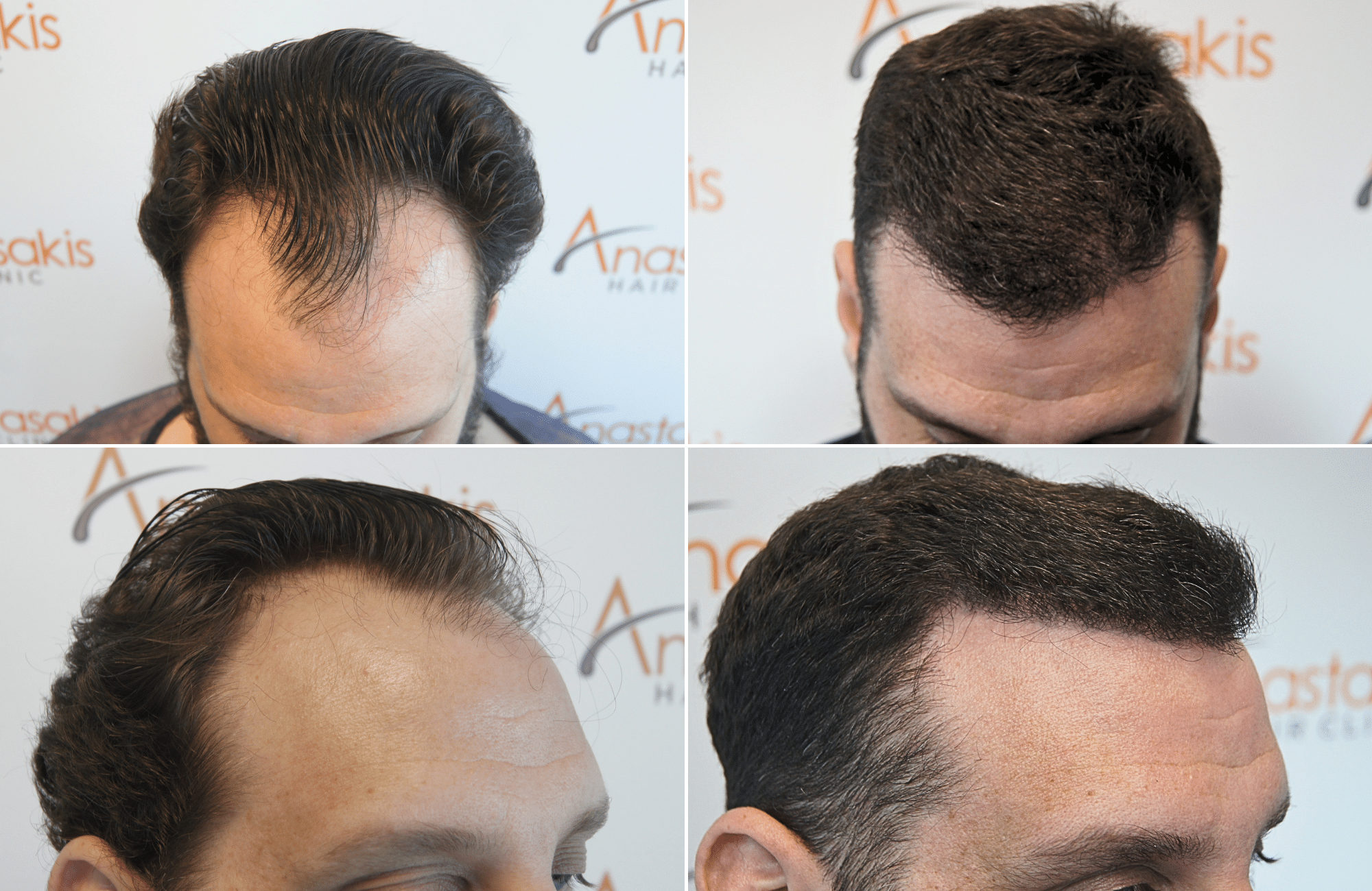 https://anastasakishairclinic.com/portfolio/apotelesma-metamosxefsis-mallion-anastasakis-hair-clinic-427/