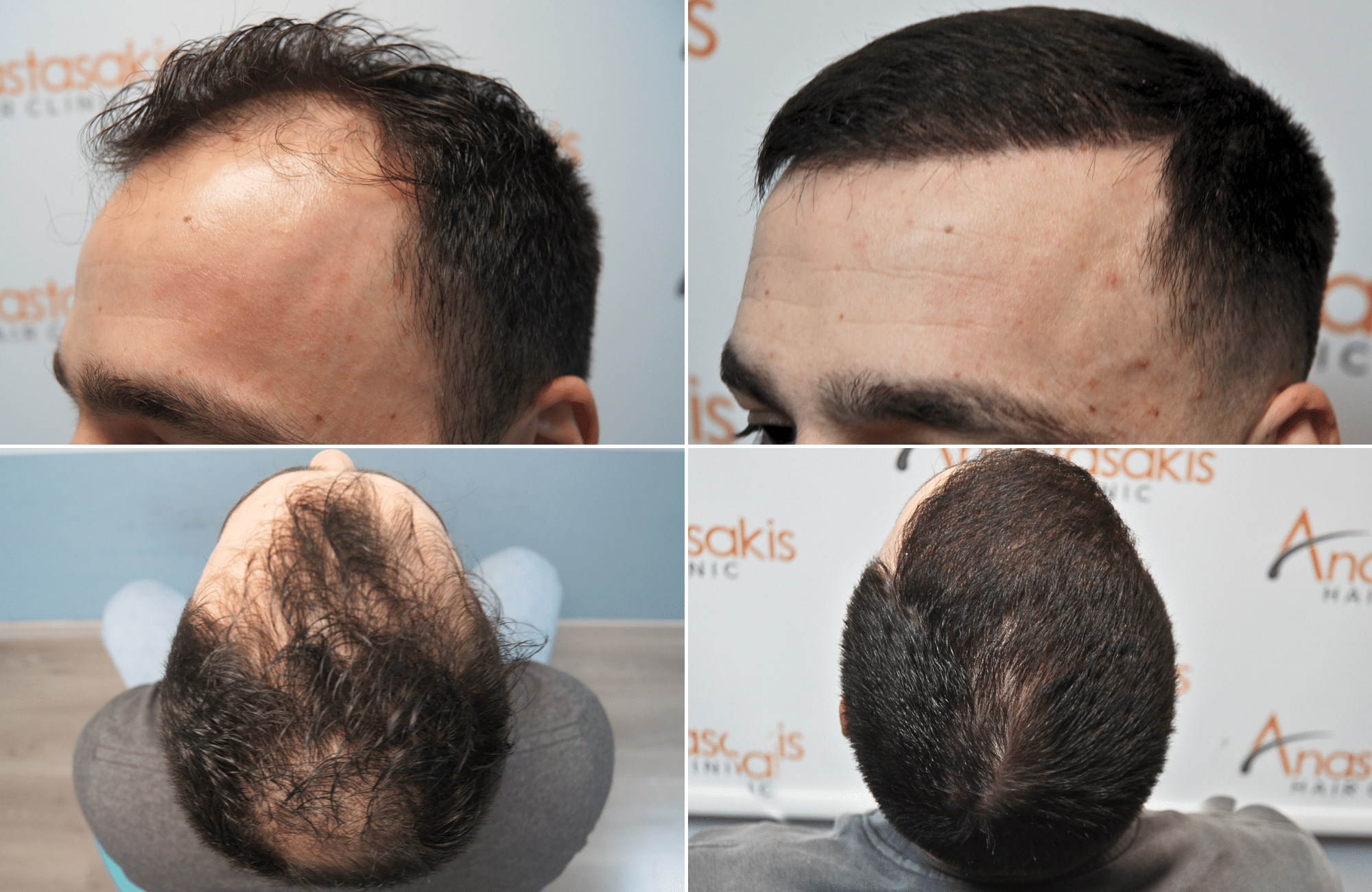 https://anastasakishairclinic.com/portfolio/apotelesma-metamosxefsis-mallion-anastasakis-hair-clinic-429/