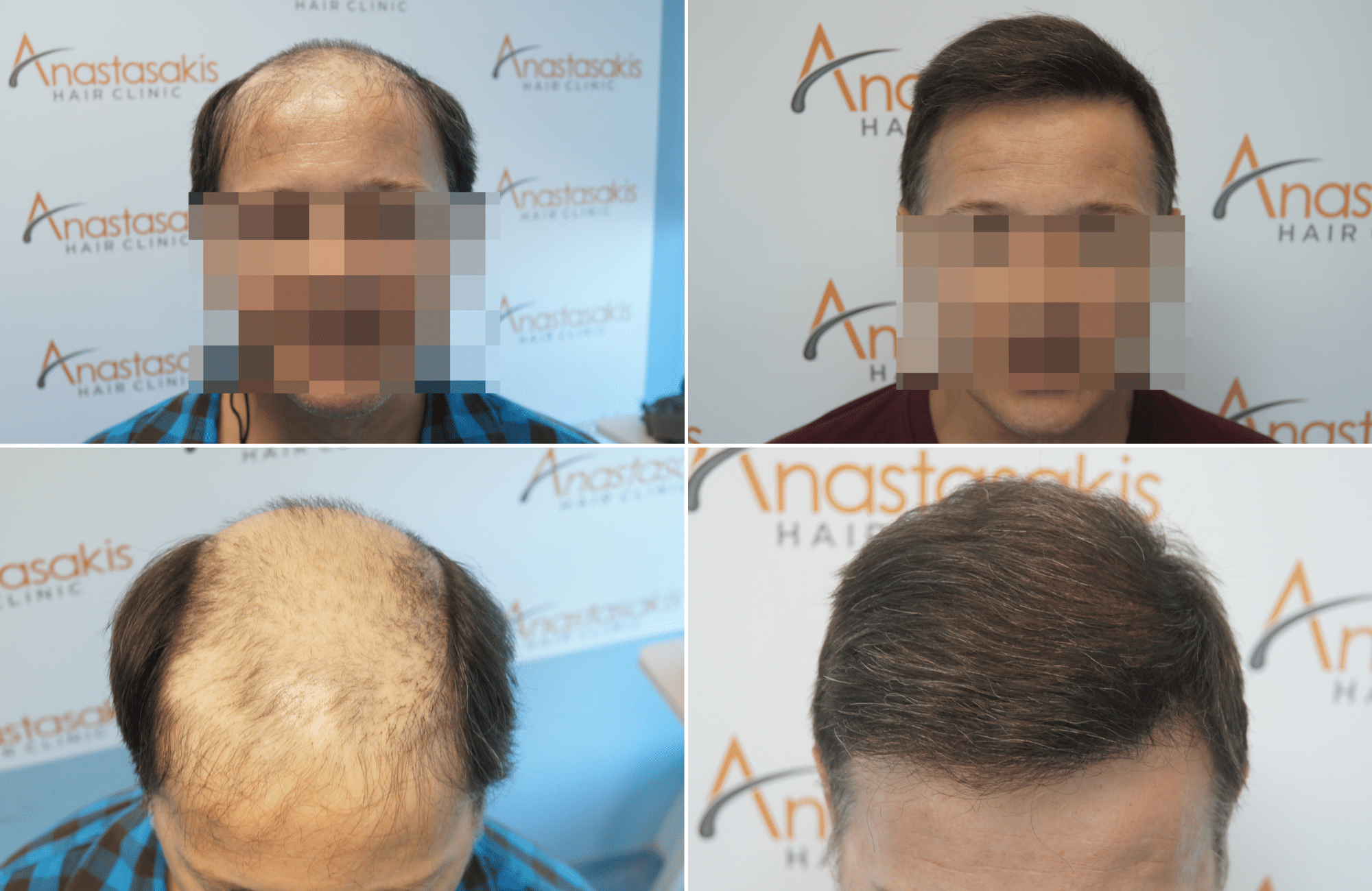 https://anastasakishairclinic.com/portfolio/apotelesma-metamosxefsis-mallion-anastasakis-hair-clinic-414/