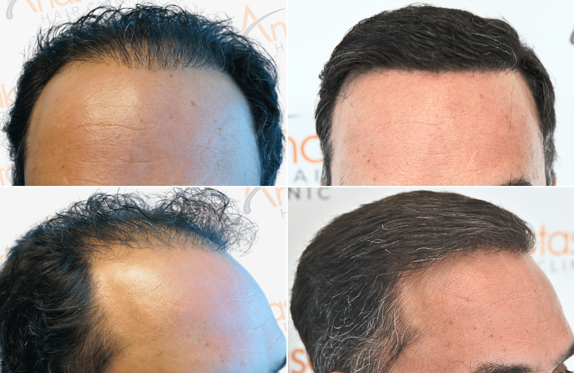 https://anastasakishairclinic.com/portfolio/apotelesma-metamosxefsis-mallion-anastasakis-hair-clinic-428/