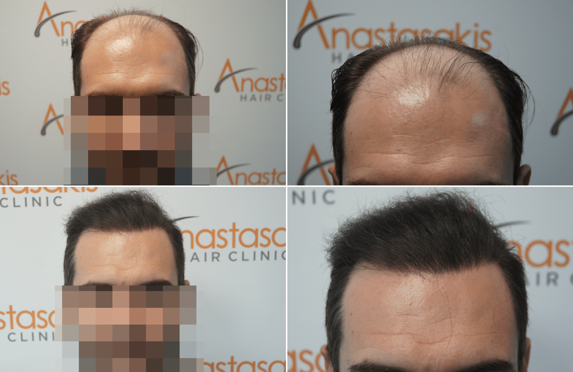 https://anastasakishairclinic.com/portfolio/apotelesma-metamosxefsis-mallion-anastasakis-hair-clinic-421/