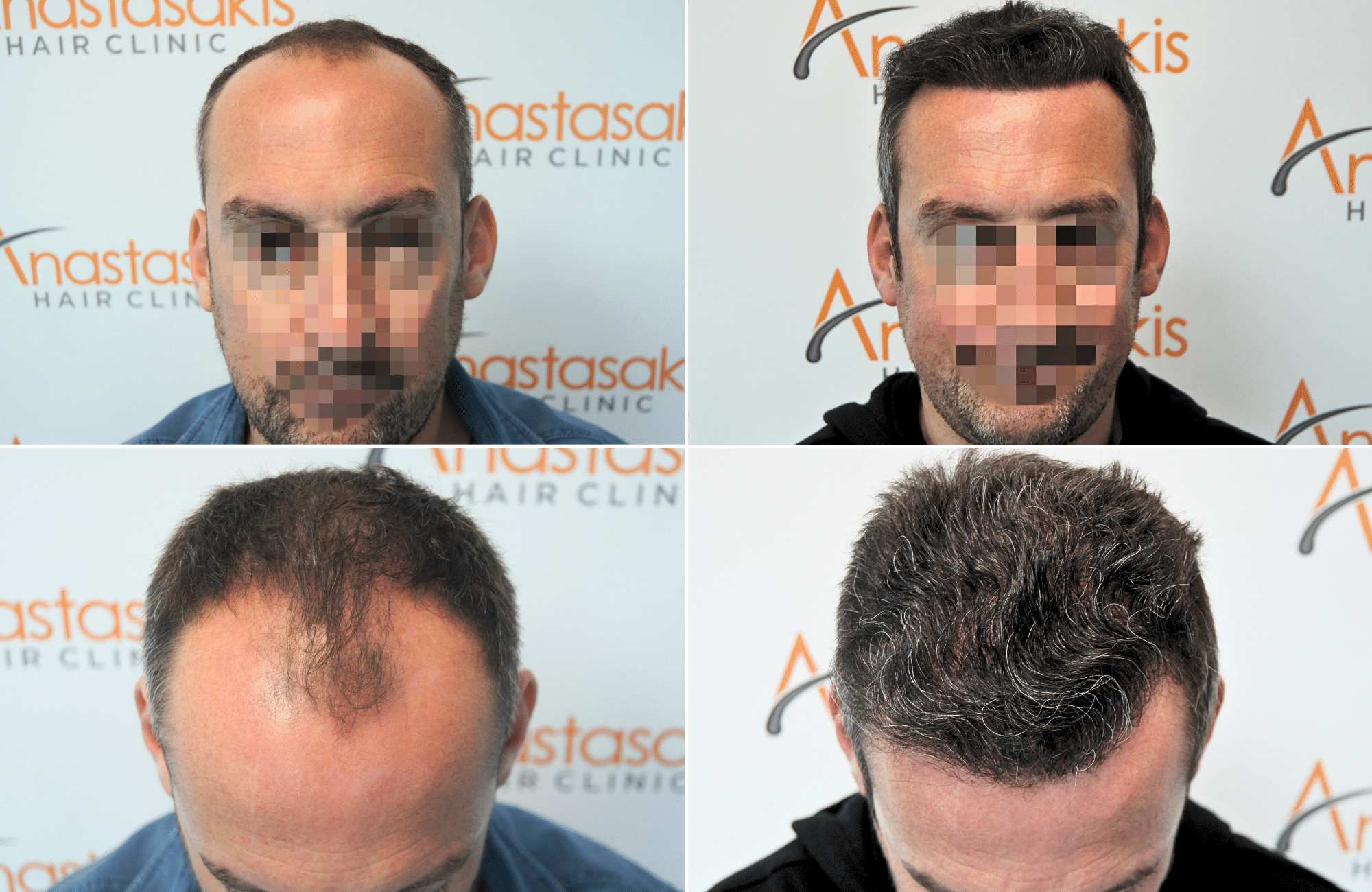 https://anastasakishairclinic.com/portfolio/apotelesma-metamosxefsis-mallion-anastasakis-hair-clinic-438/