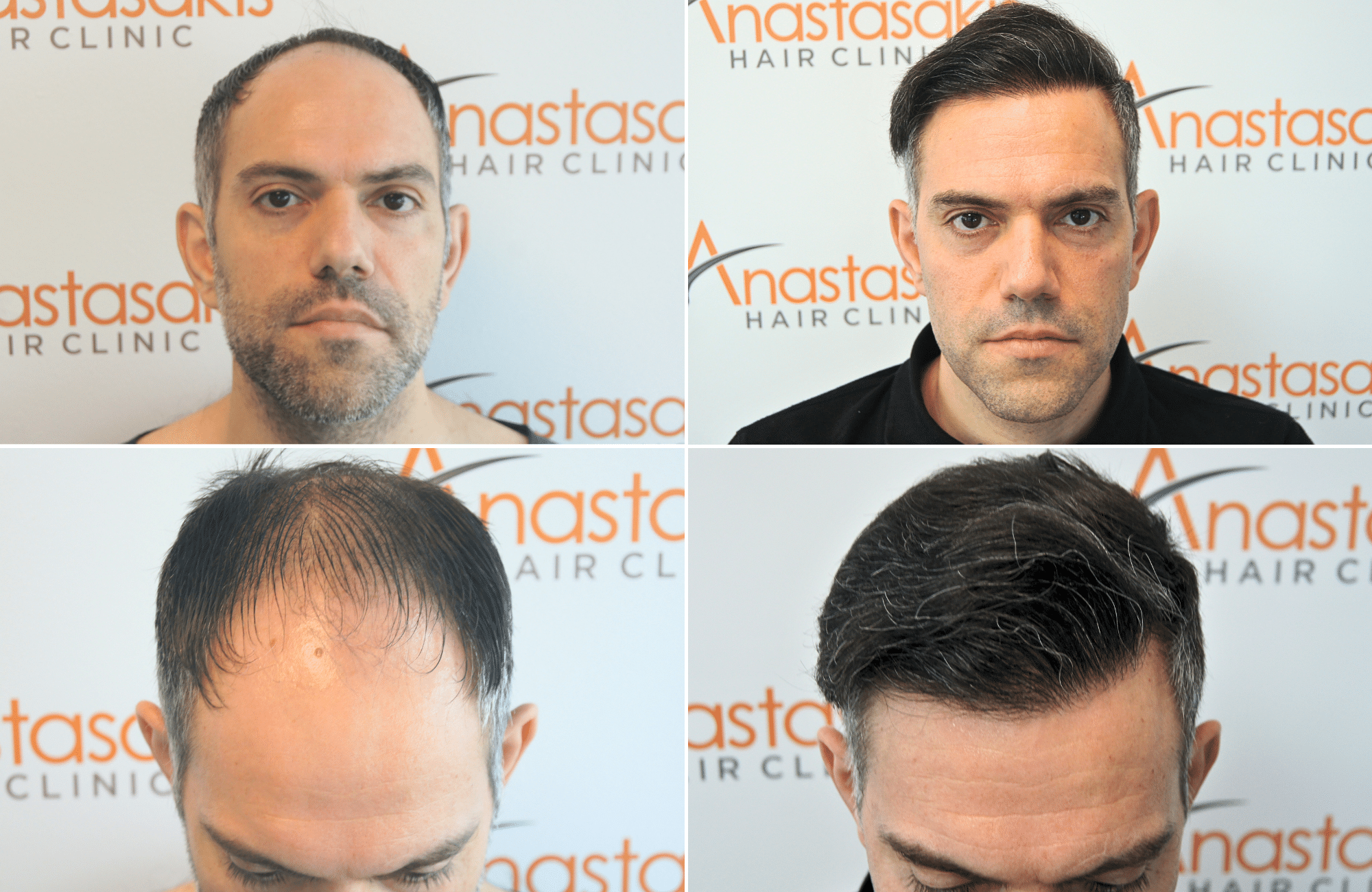 https://anastasakishairclinic.com/portfolio/apotelesma-metamosxefsis-mallion-anastasakis-hair-clinic-440/