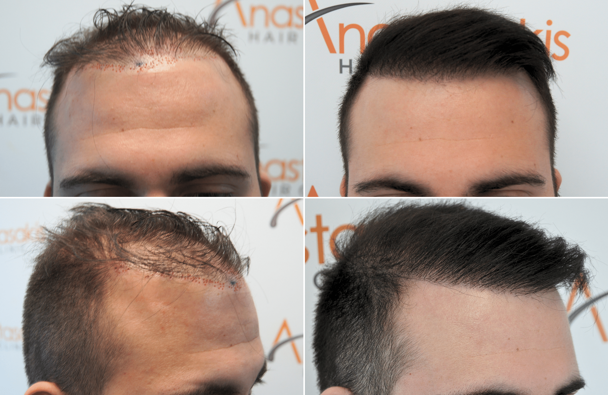 https://anastasakishairclinic.com/portfolio/apotelesma-metamosxefsis-mallion-anastasakis-hair-clinic-436/