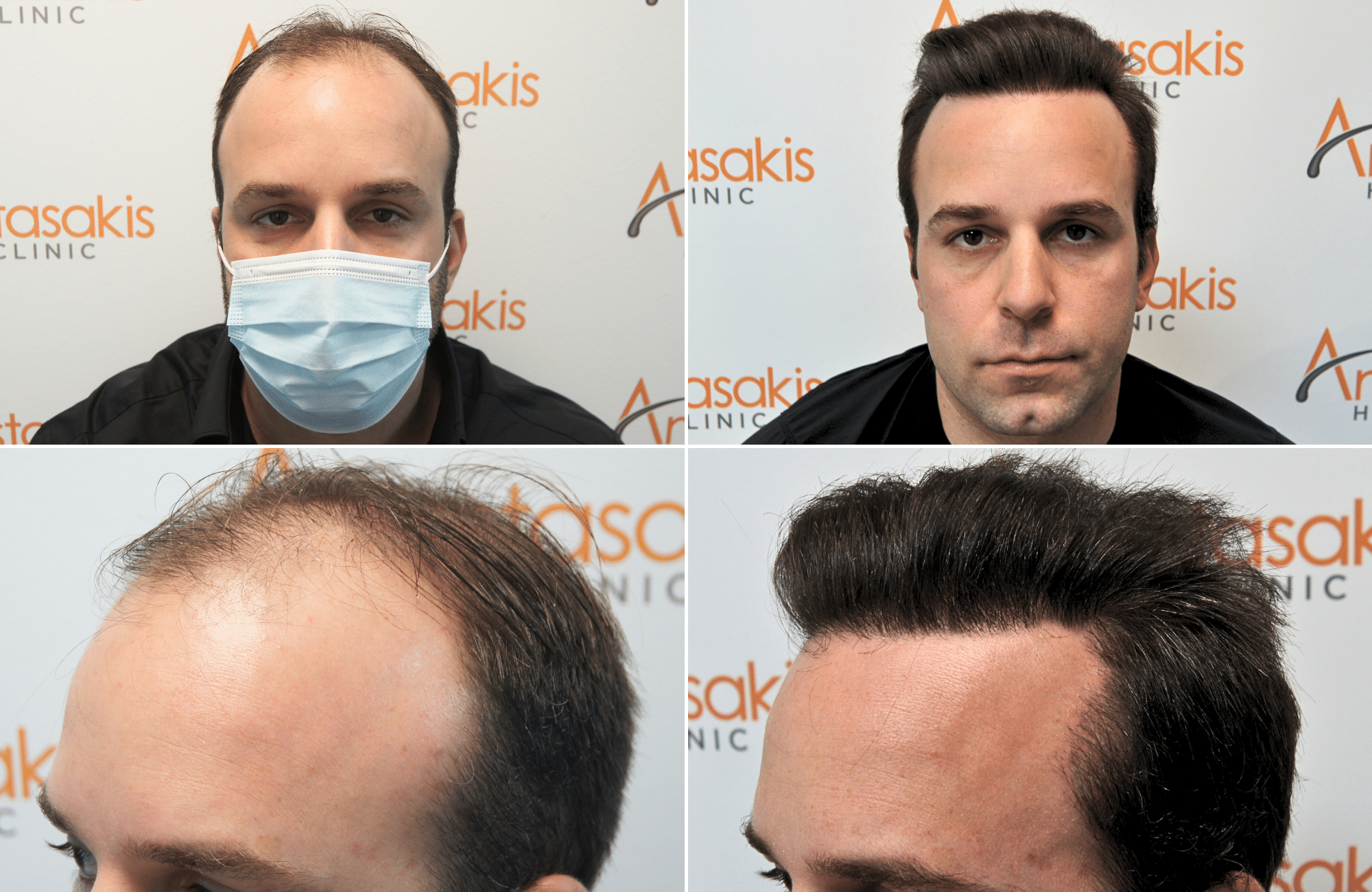 https://anastasakishairclinic.com/portfolio/apotelesma-metamosxefsis-mallion-anastasakis-hair-clinic-437/
