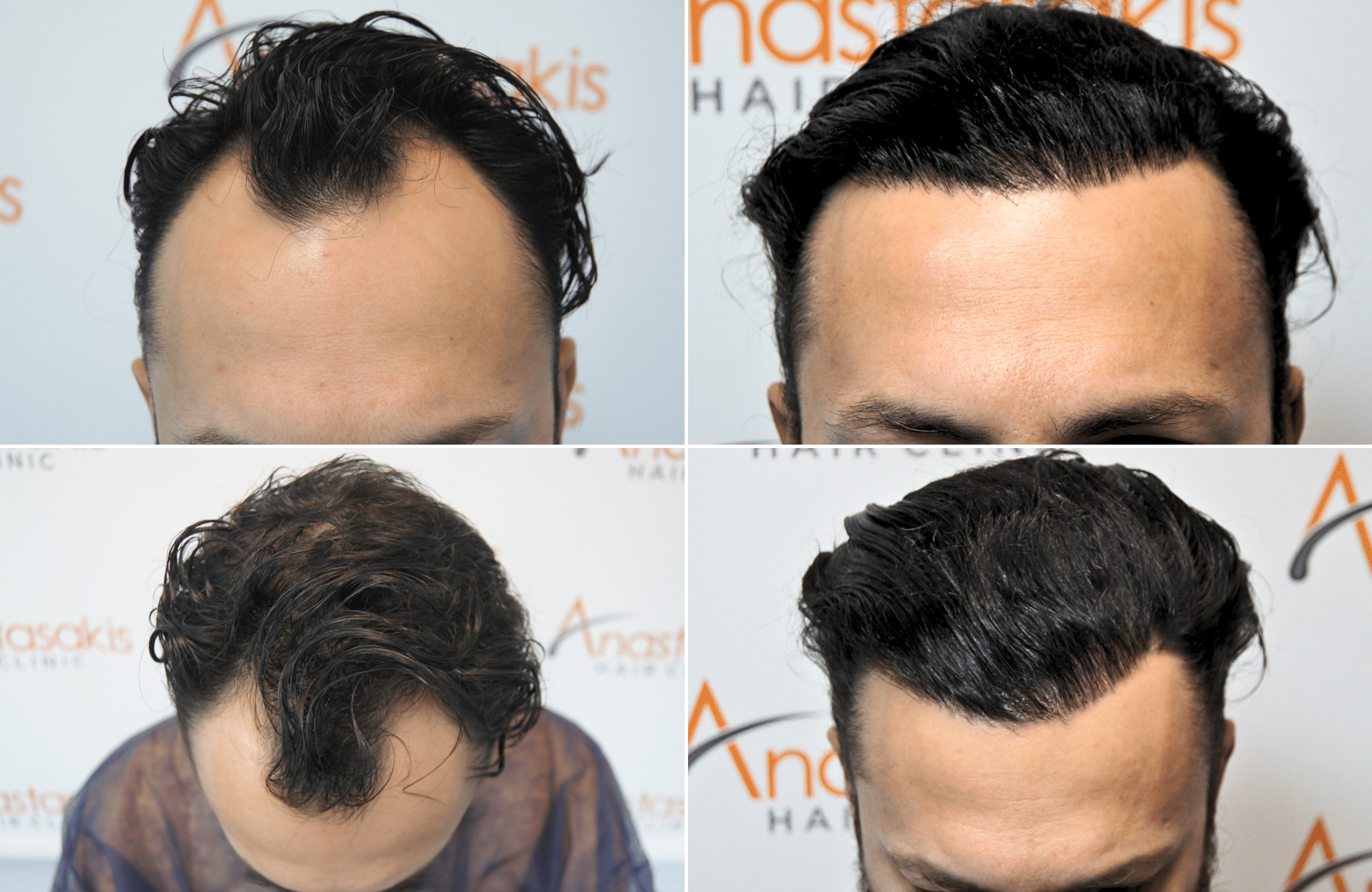 https://anastasakishairclinic.com/portfolio/apotelesma-metamosxefsis-mallion-anastasakis-hair-clinic-439/