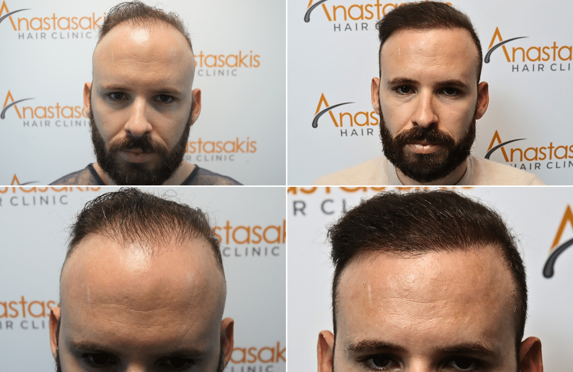 https://anastasakishairclinic.com/portfolio/apotelesma-metamosxefsis-mallion-anastasakis-hair-clinic-441/