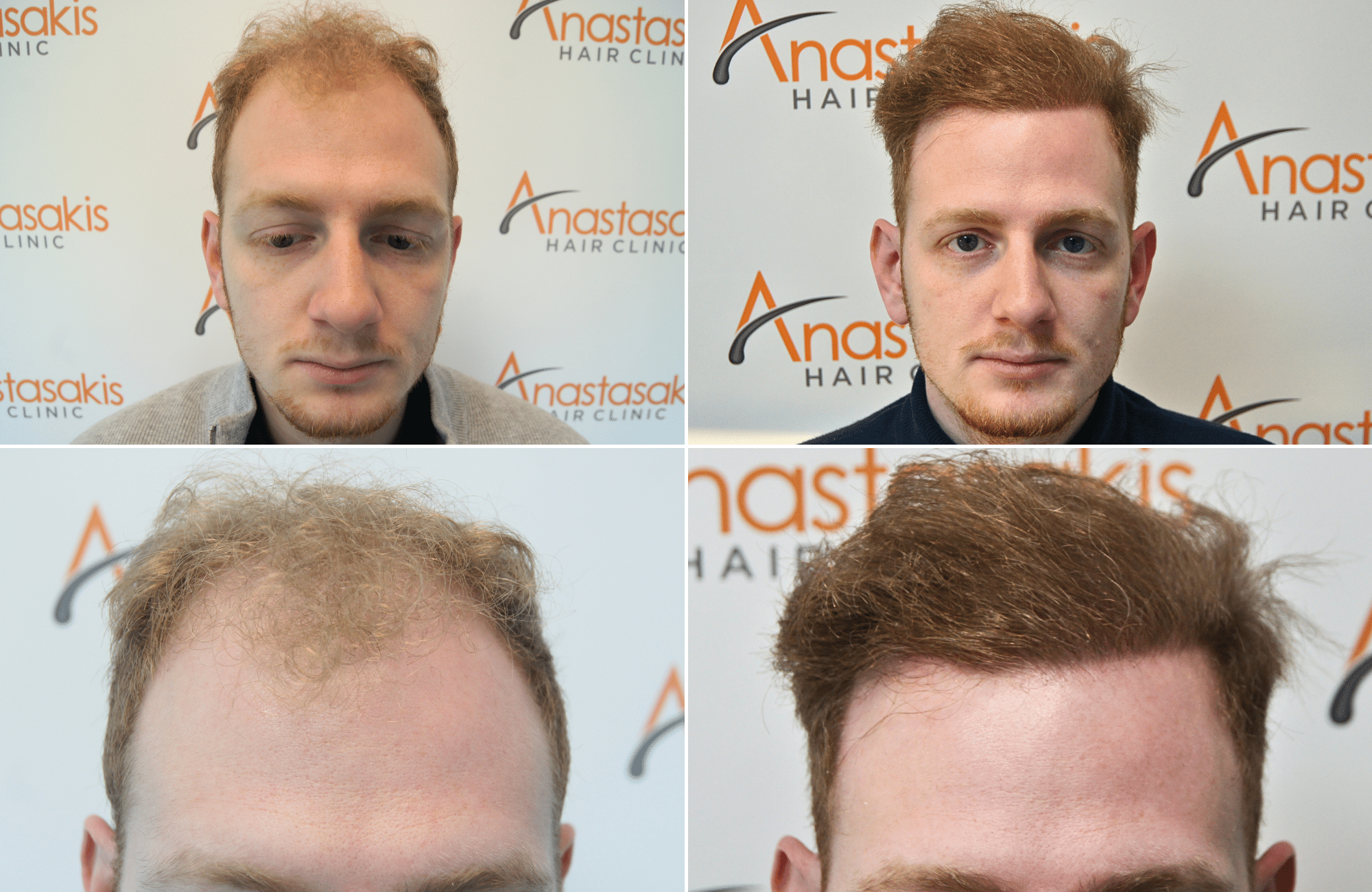 https://anastasakishairclinic.com/portfolio/apotelesma-metamosxefsis-mallion-anastasakis-hair-clinic-443/