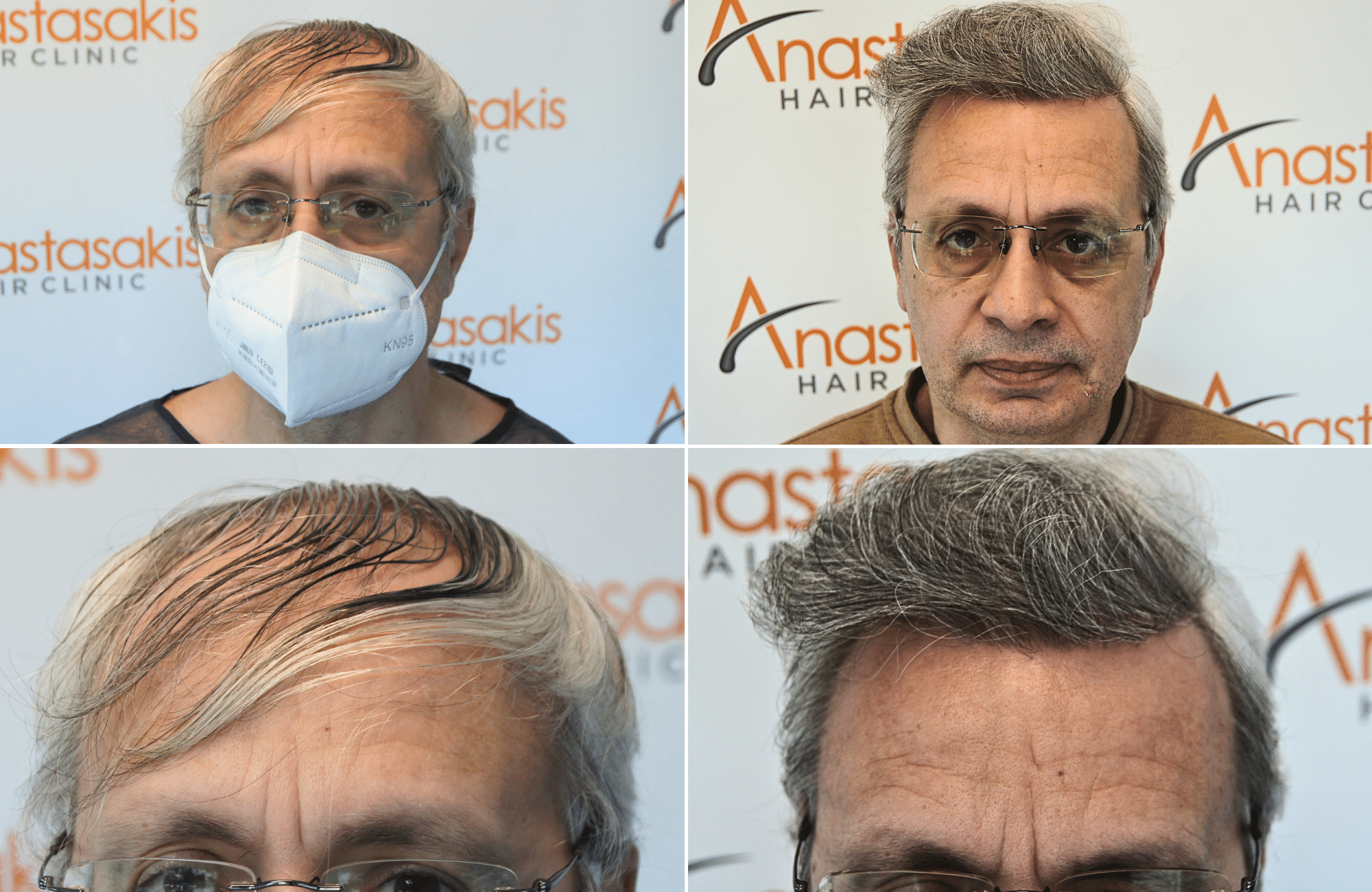 https://anastasakishairclinic.com/portfolio/apotelesma-metamosxefsis-mallion-anastasakis-hair-clinic-444/
