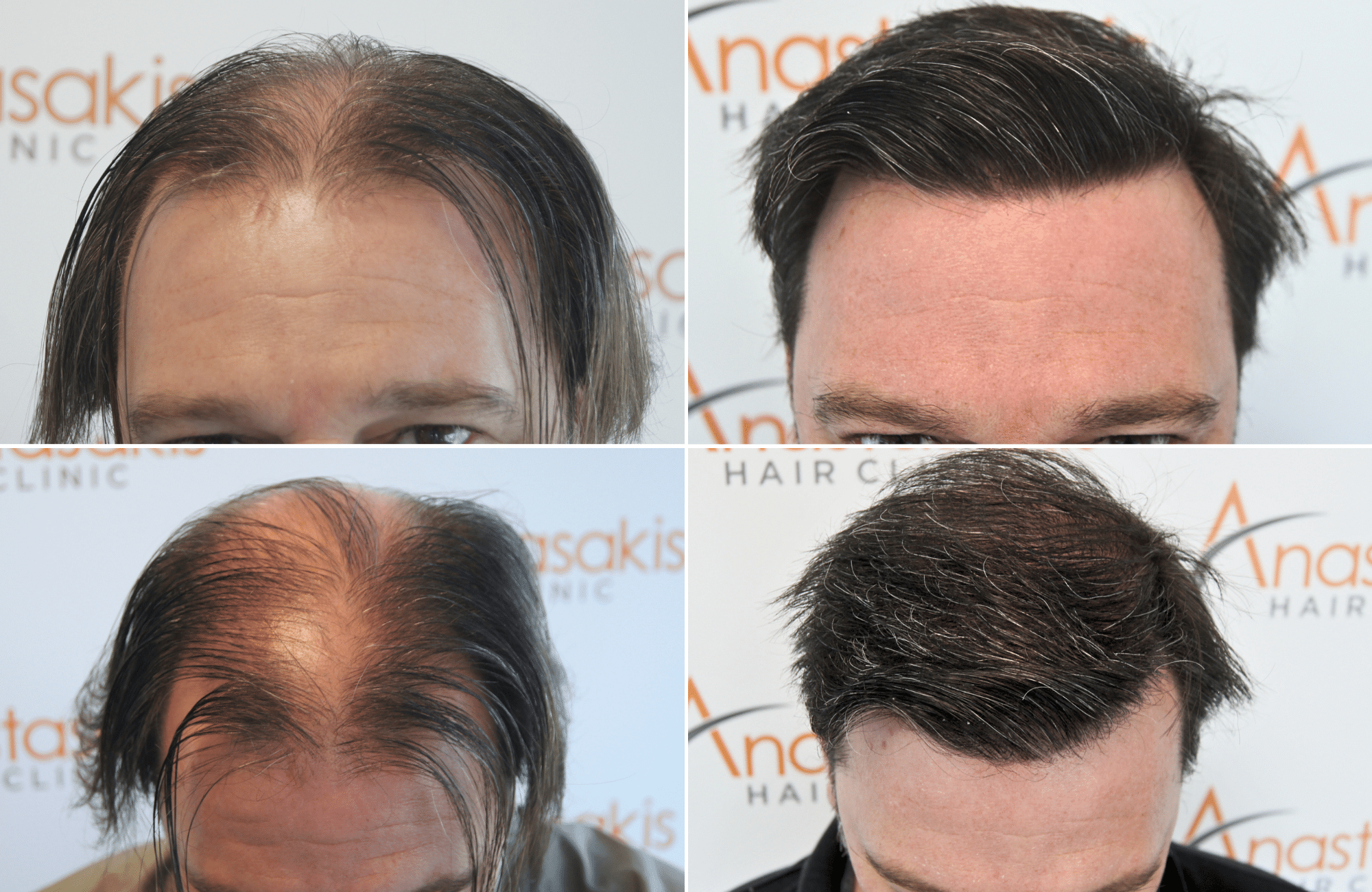 https://anastasakishairclinic.com/portfolio/apotelesma-metamosxefsis-mallion-anastasakis-hair-clinic-448/