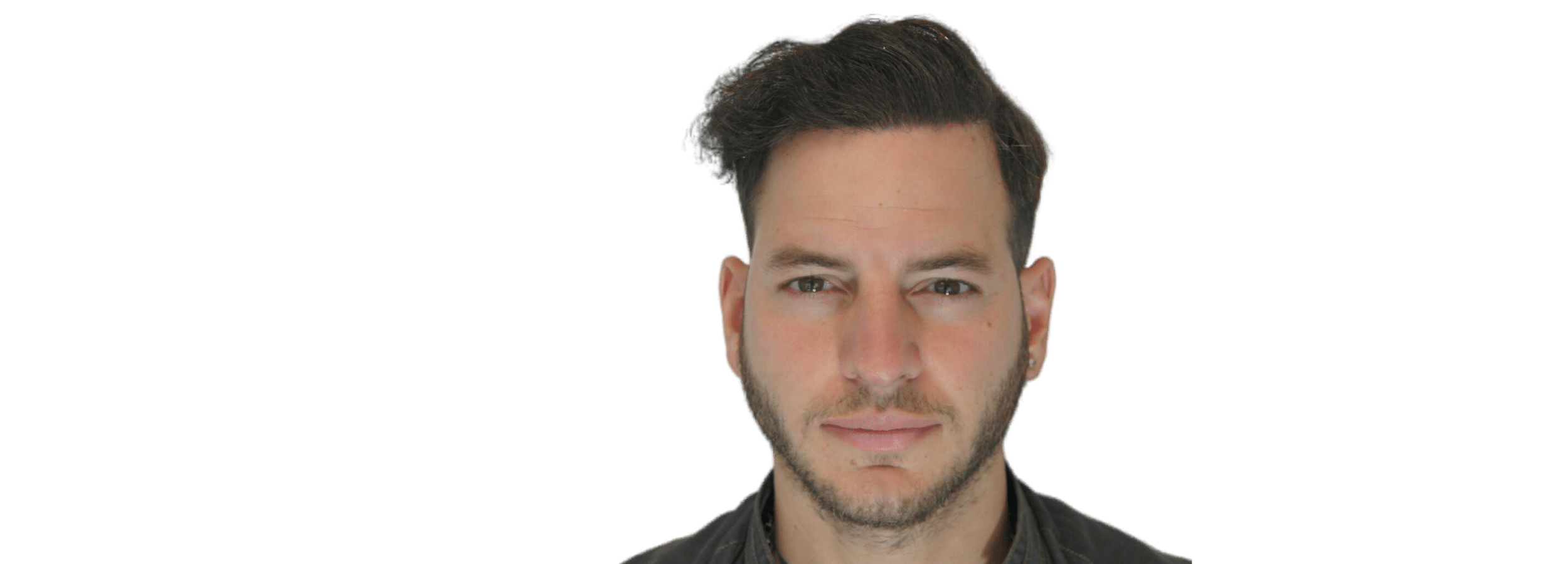 Hair Transplant with FUE and FUT – Combo