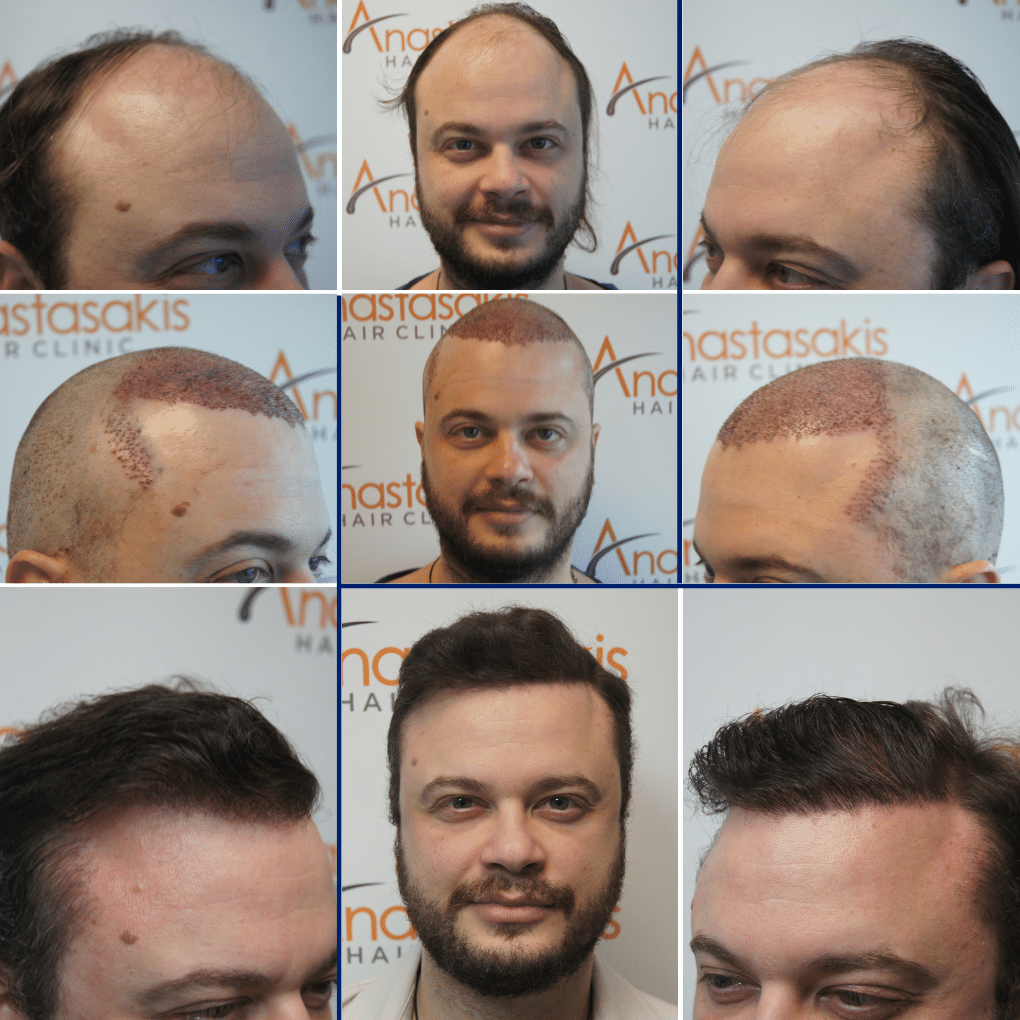 Follicular Unit Excision