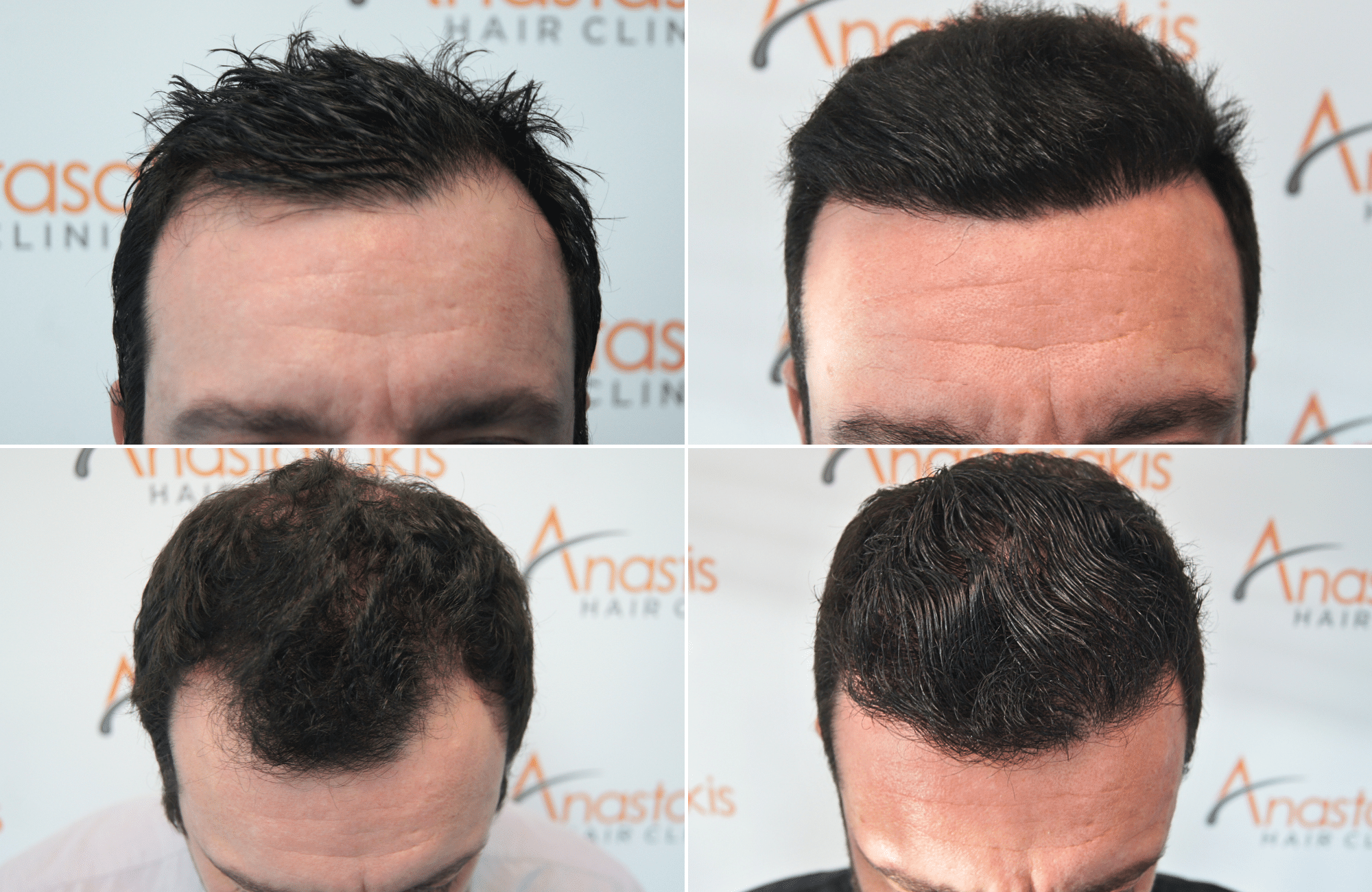 https://anastasakishairclinic.com/portfolio/apotelesma-metamosxefsis-mallion-anastasakis-hair-clinic-447/