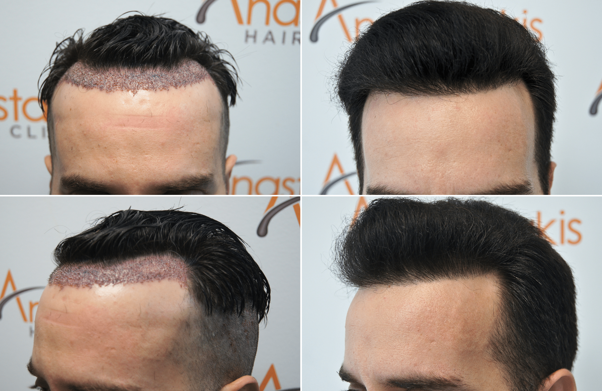 https://anastasakishairclinic.com/portfolio/apotelesma-metamosxefsis-mallion-anastasakis-hair-clinic-446/