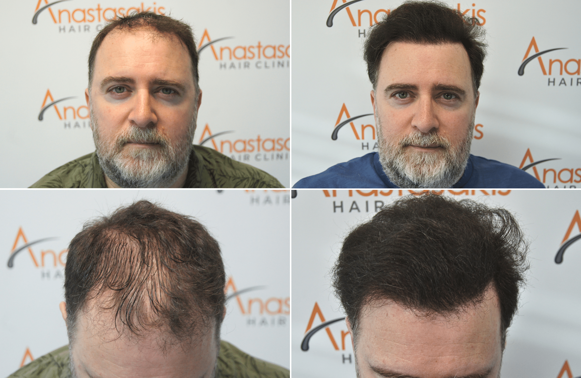 https://anastasakishairclinic.com/portfolio/apotelesma-metamosxefsis-mallion-anastasakis-hair-clinic-449/