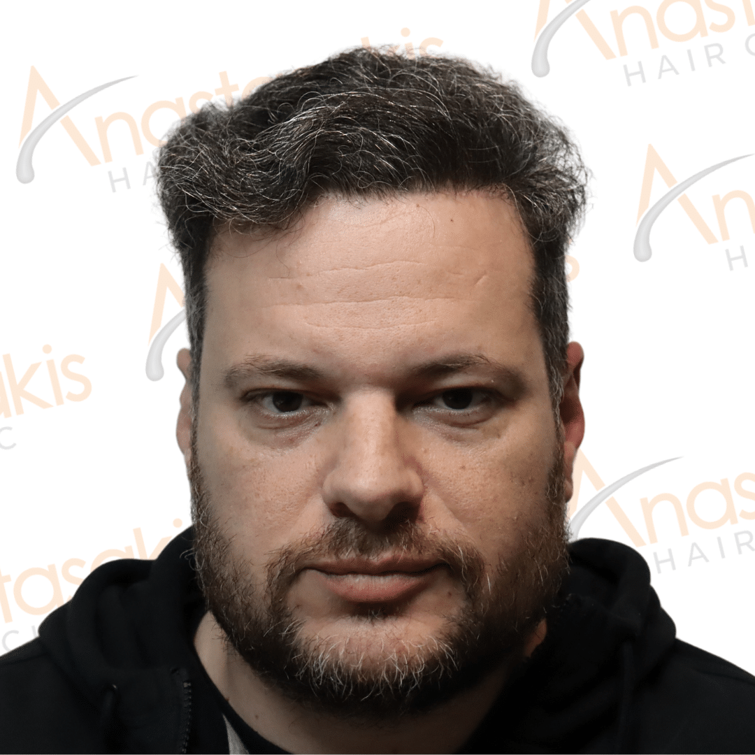 αποτελεσμα 9μηνου η μαρτυρία του ασθενούς για τη συνολική εμπειρία και το αποτέλεμά του