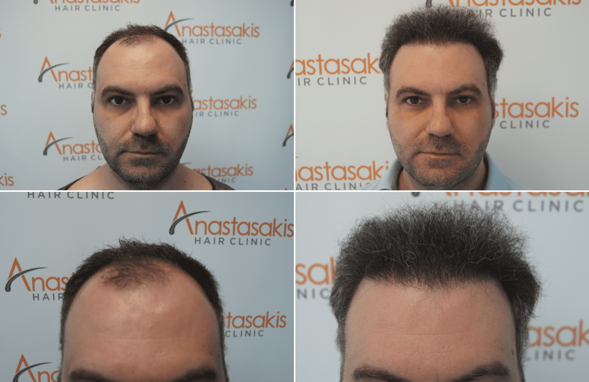 https://anastasakishairclinic.com/portfolio/apotelesma-metamosxefsis-mallion-anastasakis-hair-clinic-450-2/