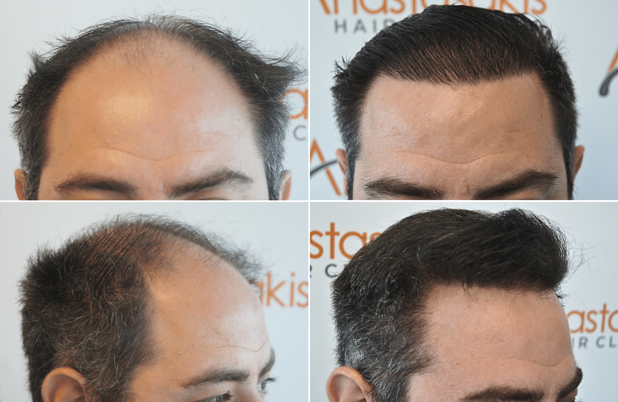 https://anastasakishairclinic.com/portfolio/apotelesma-metamosxefsis-mallion-anastasakis-hair-clinic-460/