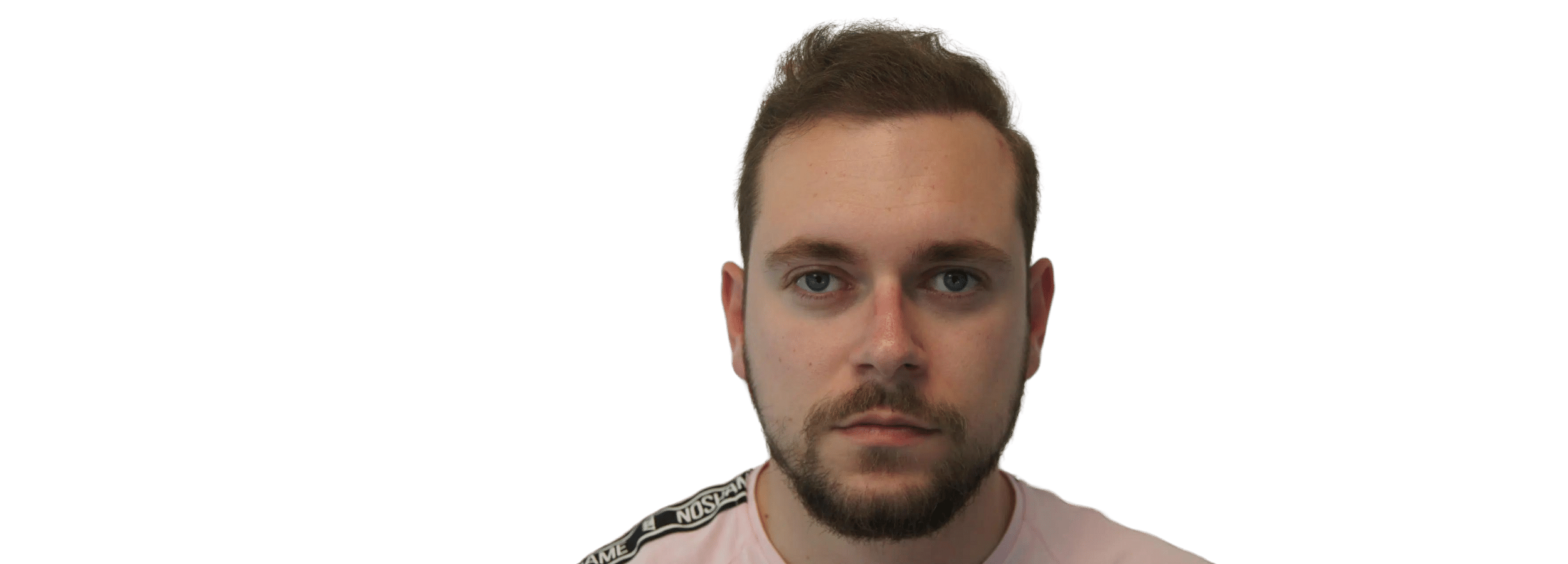 FUT Hair Transplant