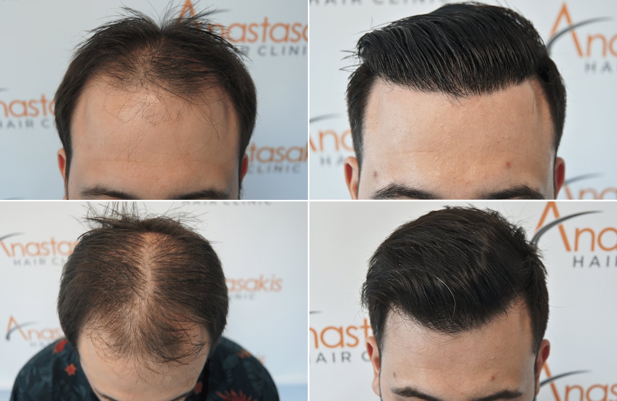 https://anastasakishairclinic.com/portfolio/apotelesma-metamosxefsis-mallion-anastasakis-hair-clinic-461/