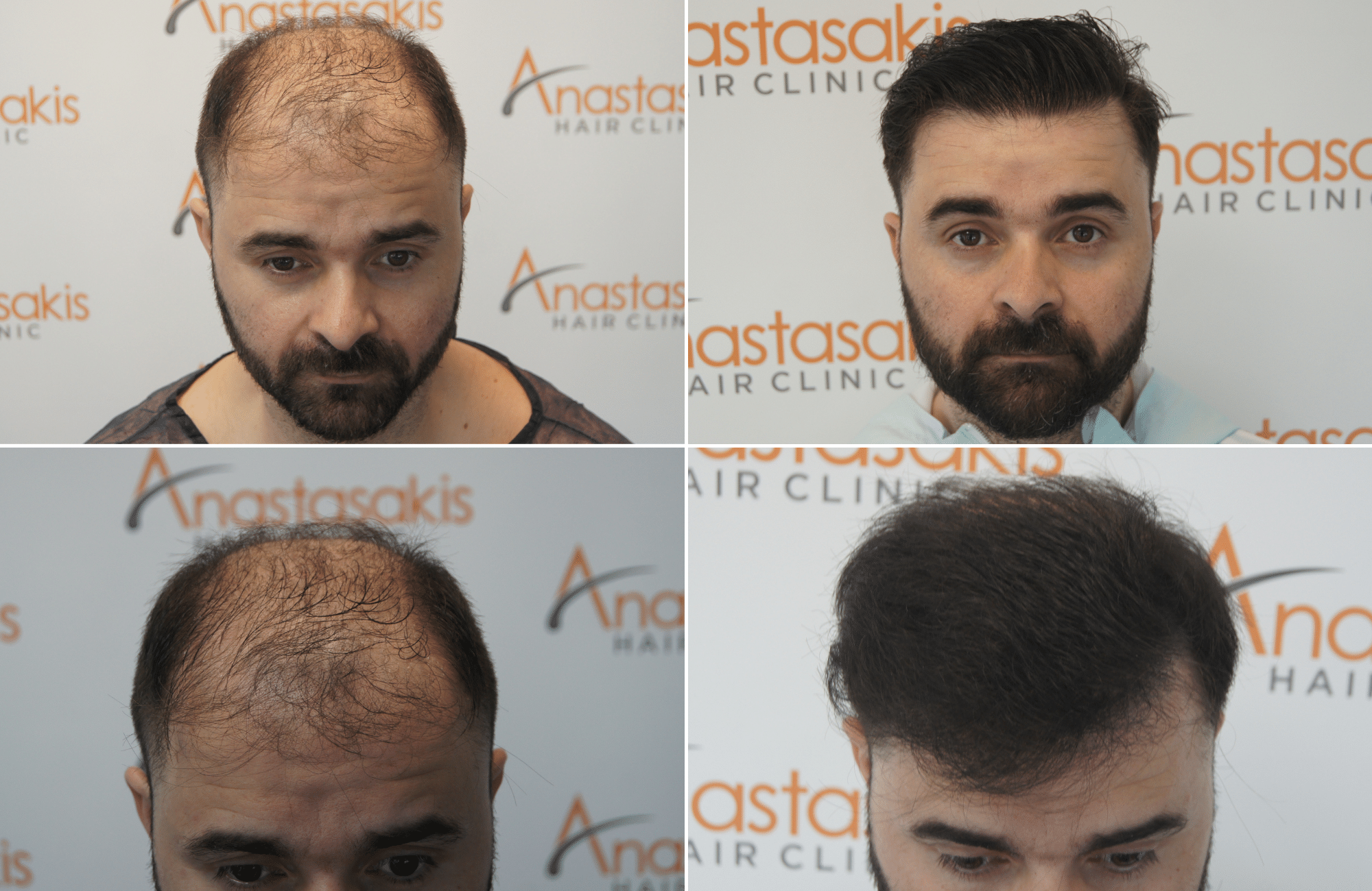 https://anastasakishairclinic.com/portfolio/apotelesma-metamosxefsis-mallion-anastasakis-hair-clinic-457/