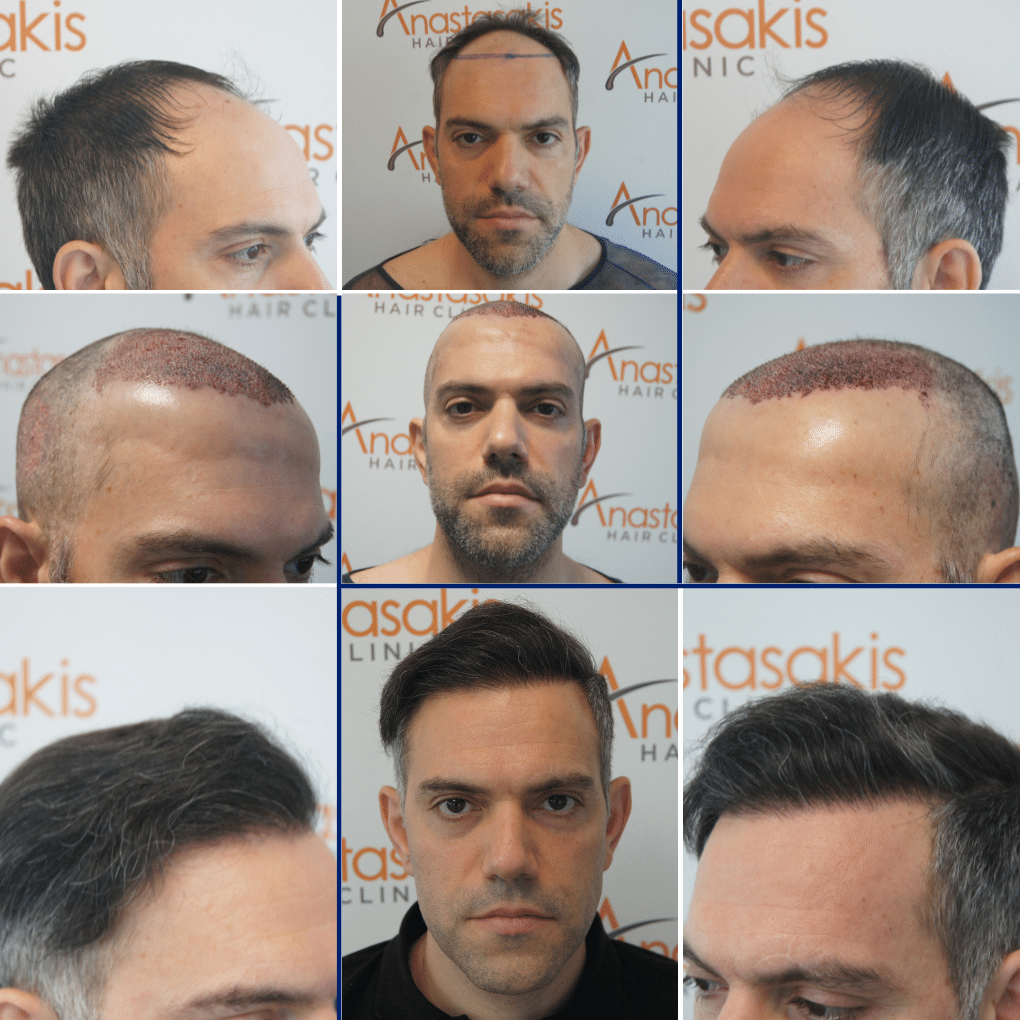 Hair Transplantation Results – Before and After Photos