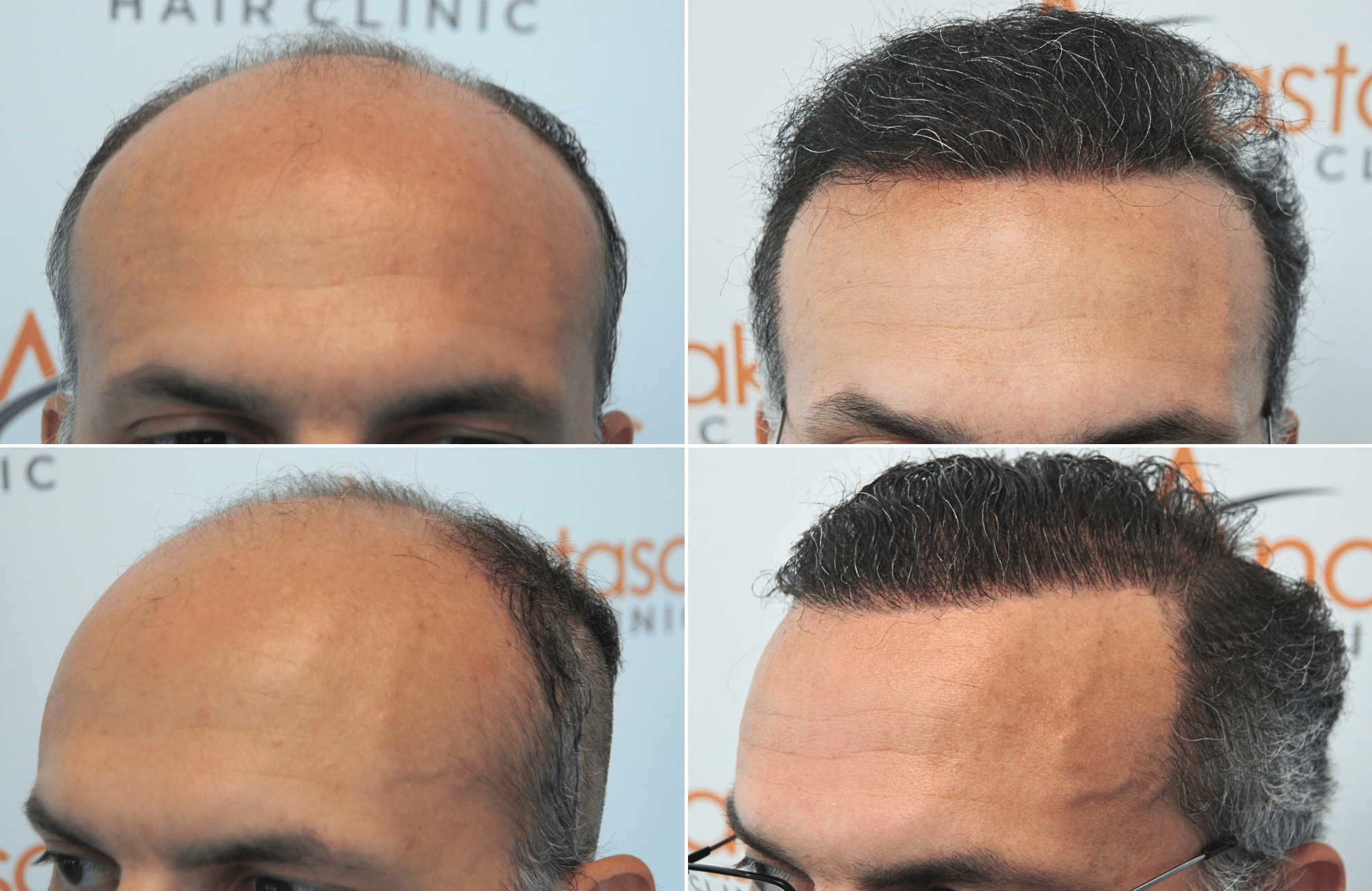 https://anastasakishairclinic.com/portfolio/apotelesma-metamosxefsis-mallion-anastasakis-hair-clinic-454/