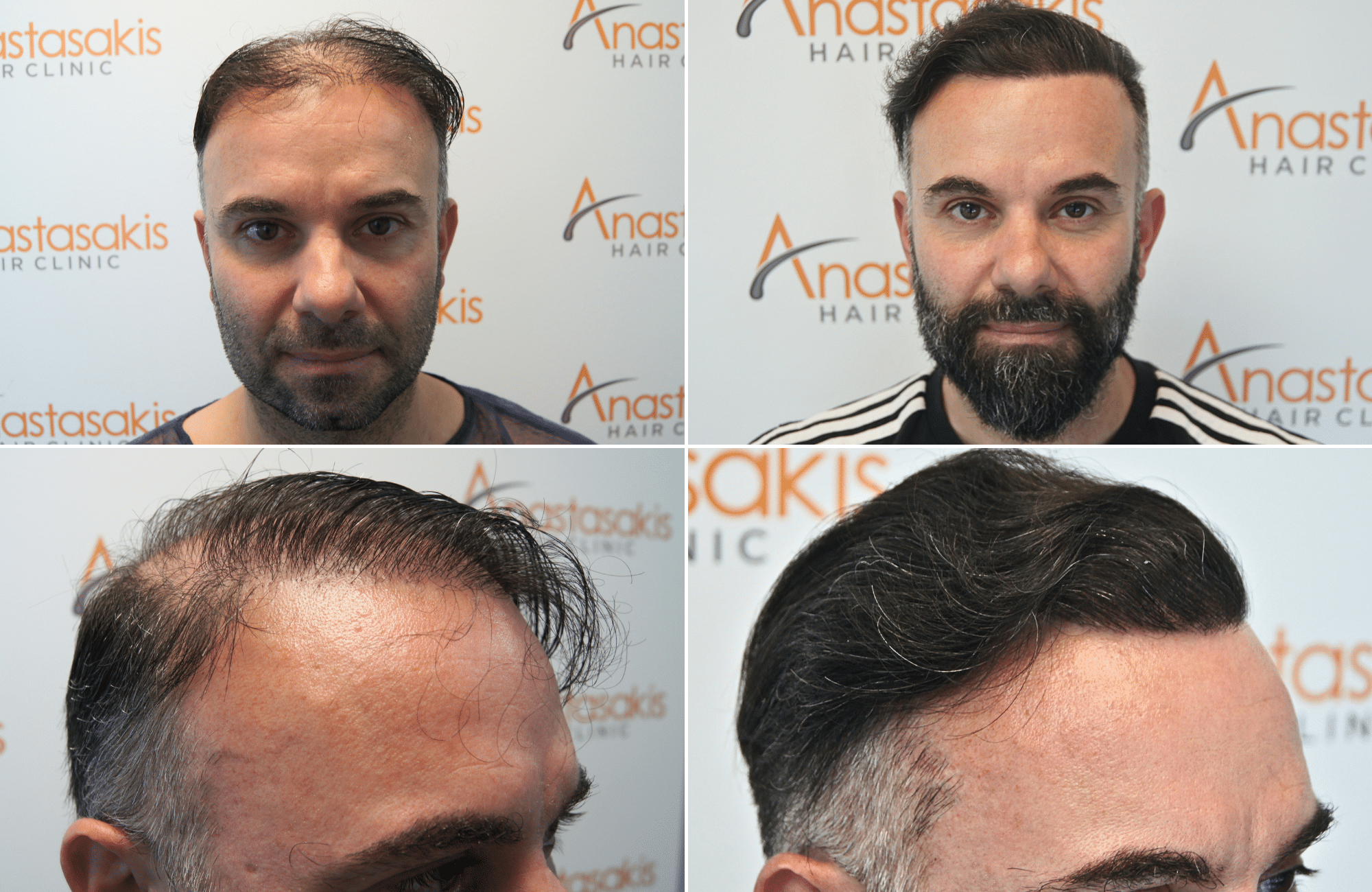 https://anastasakishairclinic.com/portfolio/apotelesma-metamosxefsis-mallion-anastasakis-hair-clinic-458/