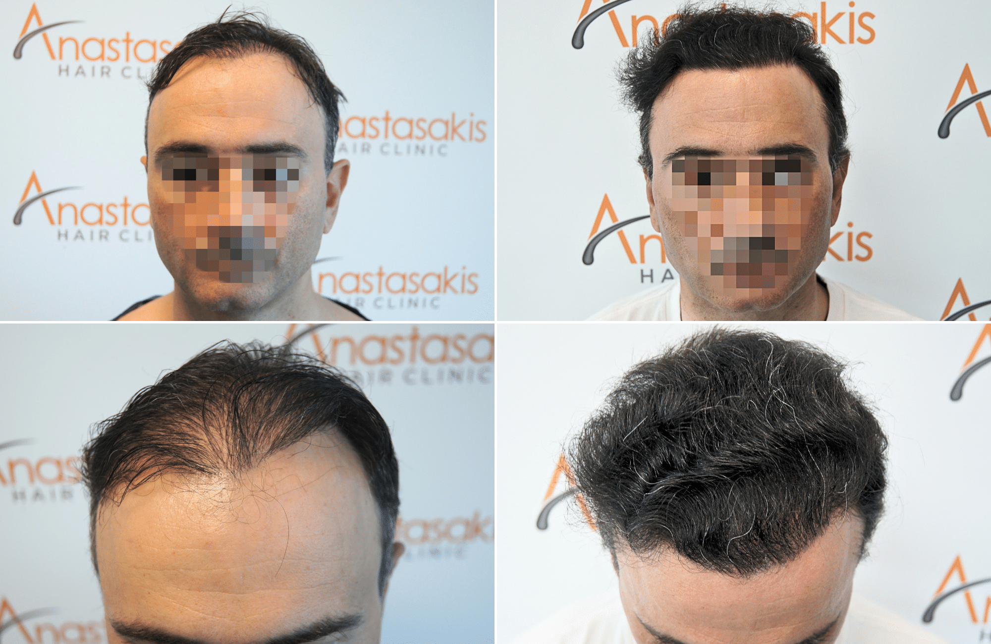 https://anastasakishairclinic.com/portfolio/apotelesma-metamosxefsis-mallion-anastasakis-hair-clinic-455/